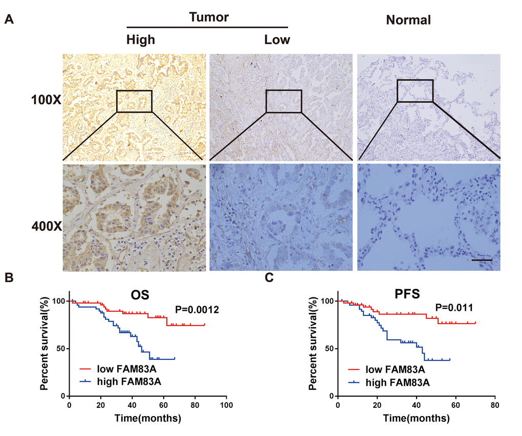 FAM83A was highly expressed in NSCLC tissues and correlated with worse survival. (A) Immunohistochemical staining showed that FAM83A was highly expressed in NSCLC tumors (n = 49/101) compared with normal lung tissues (n = 2/50, P B–C) Kaplan-Meier plots of overall-survival (B) and progression-free survival (C) in NSCLC patients with high and low levels of FAM83A. Scale bar, 100 μm.