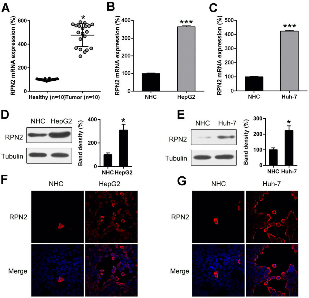 RPN2 expression in HCC cell lines and tissue specimens. (A) RPN2 expression in specimens obtained from HCC patients (n = 20) vs normal healthy tissue (n = 20). (B, C) mRNA level of RPN2 in Huh-7 and HepG2 cells was determined by qPCR. (D, E) Protein expression of RPN2 in HCC cell lines, Huh-7and HepG2, as well as normal hepatic cells (NHC) was detected by WB. (F, G) Subcellular localization of RPN2 in HCC cell lines, Huh-7 and HepG2, was detected by immunofluorescence. RPN2 and nuclear DNA were stained with anti-RPN2 antibody (red) and DAPI (blue) respectively. Merged image showed the subcellular localization of RPN2. Images were captured on a fluorescence microscope. The band of target protein was normalized to the density of action. The quantification was performed independently in a single band. The experiments were performed three times. Results are recorded as mean ± SD. *P P .