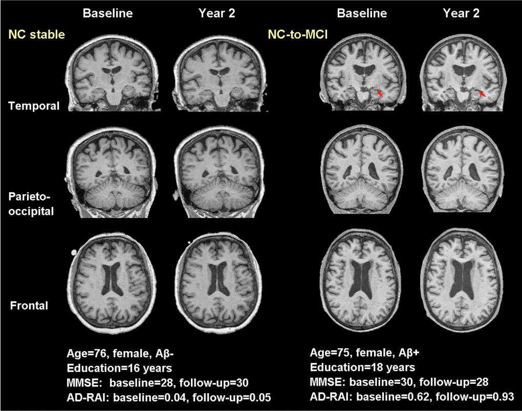 Typical real cases of NC stable and NC-to-MCI subjects. T1-weighted (T1W) images at baseline and two years were shown for the two typical cases in temporal, parieto-occipital and frontal view. Red arrows pointed to the region with significant atrophy by comparing the T1W images of the same subject over two years. The typical case of NC stable did not present atrophy while the case of NC-to-MCI showed increased width of left choroid fissure and temporal horn (temporal view). Aβ-: CSF-based Aβ42 >192 pg/ml at baseline and 2 years; Aβ+: CSF-based Aβ42 
