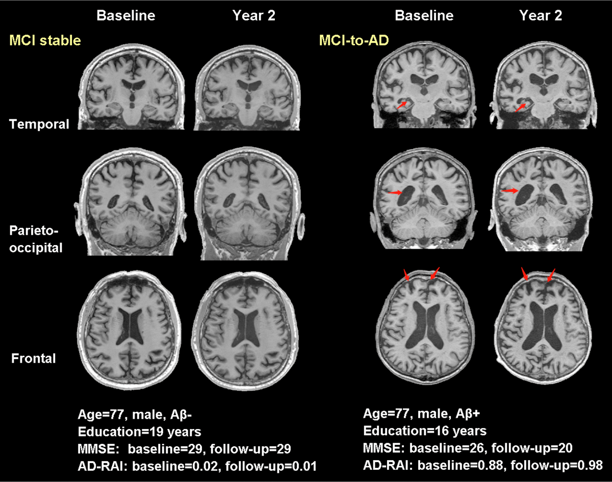 Frontiers A Meta Analysis Of Cognitive Impairment And Decline