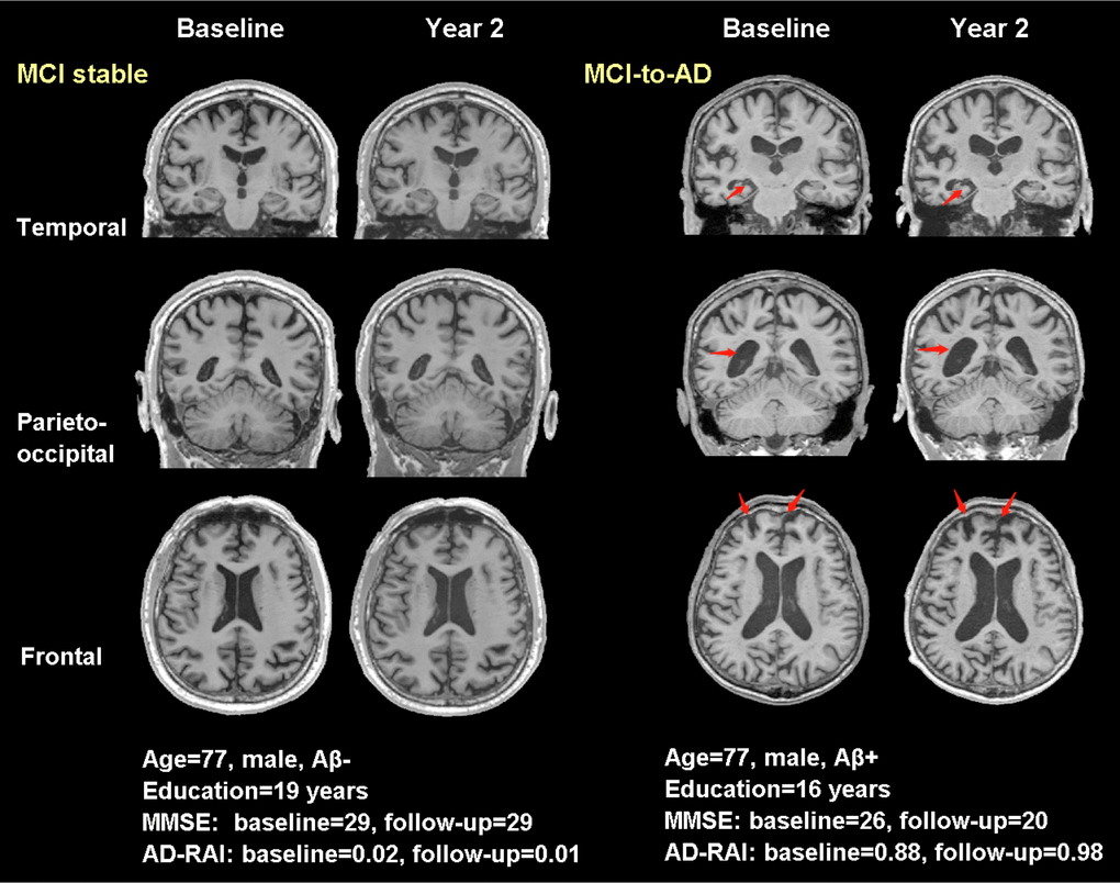 Typical real cases of MCI stable and MCI-to-AD subjects. T1-weighted (T1W) images at baseline and two years were shown for the two typical cases in temporal, parieto-occipital and frontal view. Red arrows pointed to the regions with significant atrophy by comparing the T1W images of the same subject over two years. The typical case of MCI stable did not present progressed atrophy during the two years, while the case of MCI-to-AD showed increased width of right choroid fissure and temporal horn (temporal view), enlargement of lateral ventricle (parieto-occipital view) and increased frontal lobe atrophy (frontal view). Aβ-: CSF-based Aβ42 >192 pg/ml at baseline and 2 years; Aβ+: CSF-based Aβ42 