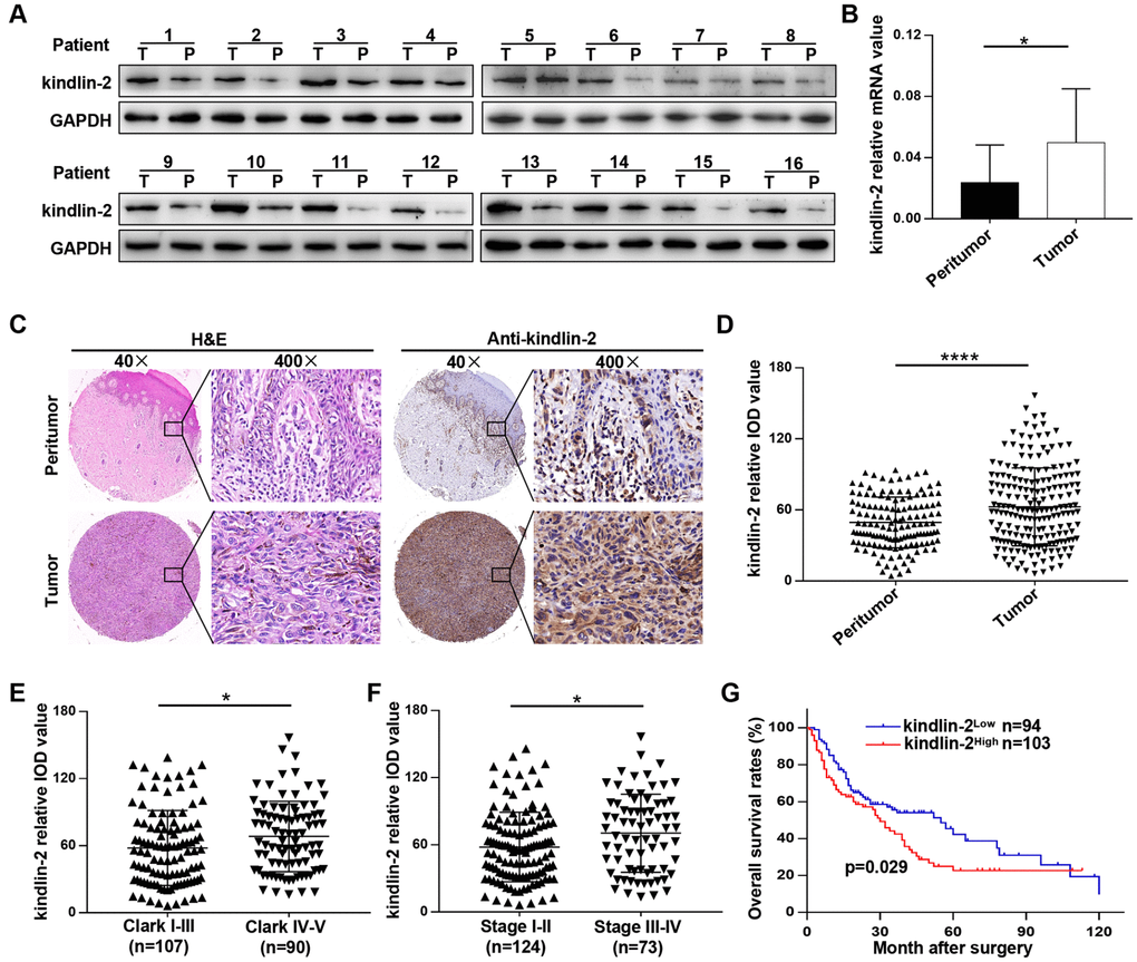 Kindlin-2 is overexpressed in melanoma, and elevated kindlin-2 predicts a poor prognosis. (A) The protein levels of kindlin-2 in 16 pairs of melanoma and matched peri-tumour tissues. (B) The mRNA levels of kindlin-2 in 16 pairs of melanoma and matched peri-tumour tissues. (C) Representative images of the TMA after H&E staining and IHC staining with the kindlin-2 antibody. (D) The kindlin-2 expression levels in melanoma and peritumoural tissues were analysed by average densitometry. (E and F) The kindlin-2 levels in different groups were analyzed according to the Clark level and clinical stage. (G) Overall survival analysis of 197 melanoma patients according to the expression of kindlin-2. *p****p