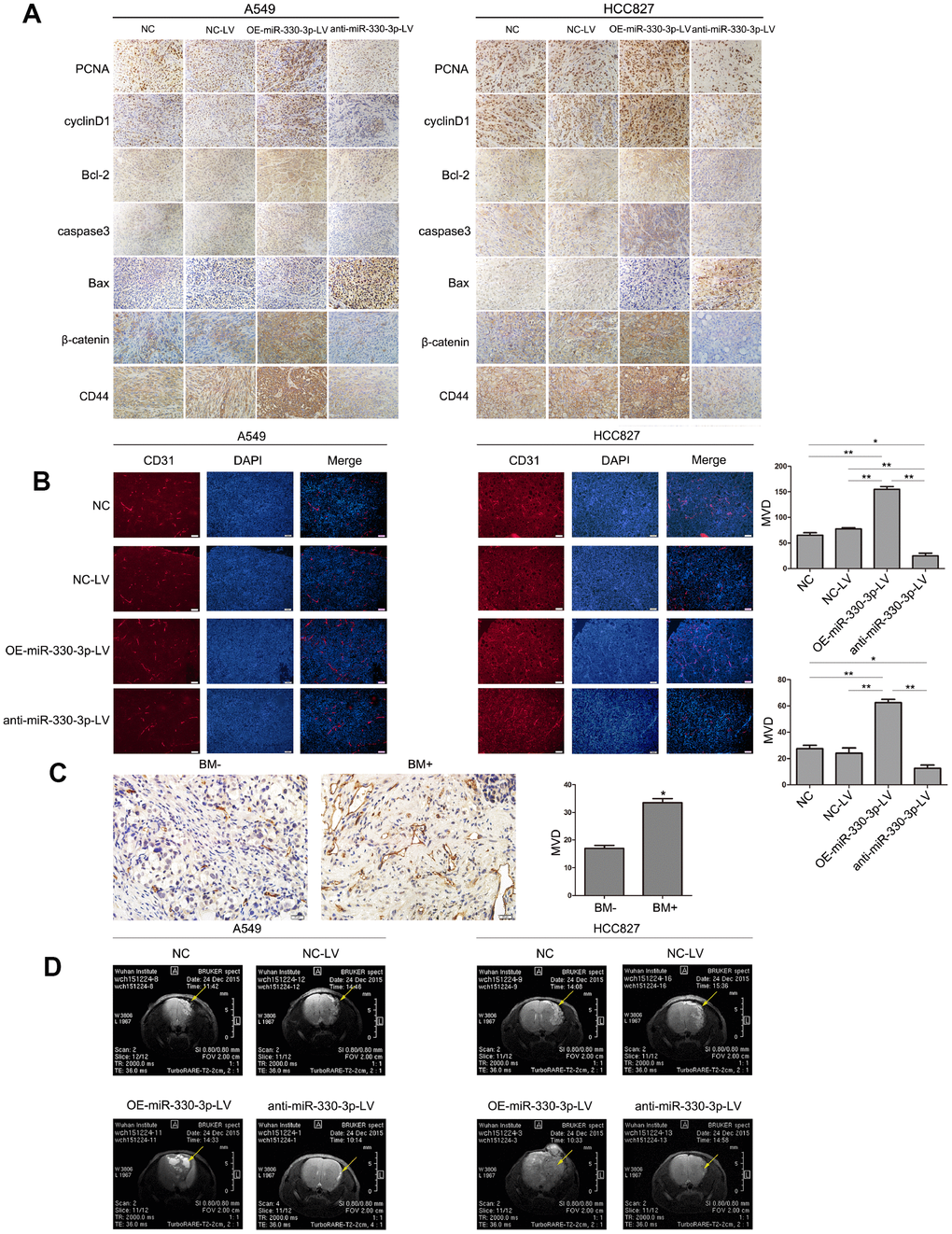 MiR-330-3p induces tumor metastasis and angiogenesis in BM model. (A) Immunohistochemical analysis of PCNA, cylinD1, Bcl-2, caspase3, Bax, CD44 and β-catenin expression in tissue sections of GFP-labeled tumors isolated from mice injected with A549 and HCC827 cells transfected with NC-LV, OE-miR-330-3p-LV or anti-miR-330-3p-LV. (B, C) Representative images of CD31-positive endothelial cells in tumor tissues of mice (B) and NSCLC patients (C). *P P D) MRI images of metastatic tumors in the brain. Representative MRI of tumors is shown. A representative experiment of three was reported.