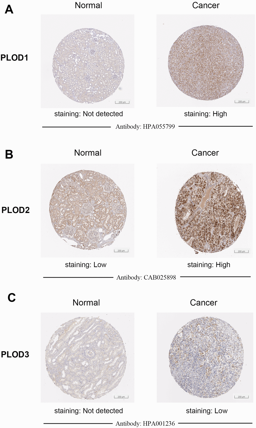 Representative proteins expressions of IHC images of distinct PLODs family members were detected in ccRCC and normal tissues (Human Protein Atlas). (A–C) PLOD1/3 proteins were found not expressed in normal renal tissues, while significantly high staining expressions were observed in ccRCC tissues. (B) PLOD2 protein was detected low expressed in normal renal tissues, while high protein expressions were observed in ccRCC tissues.