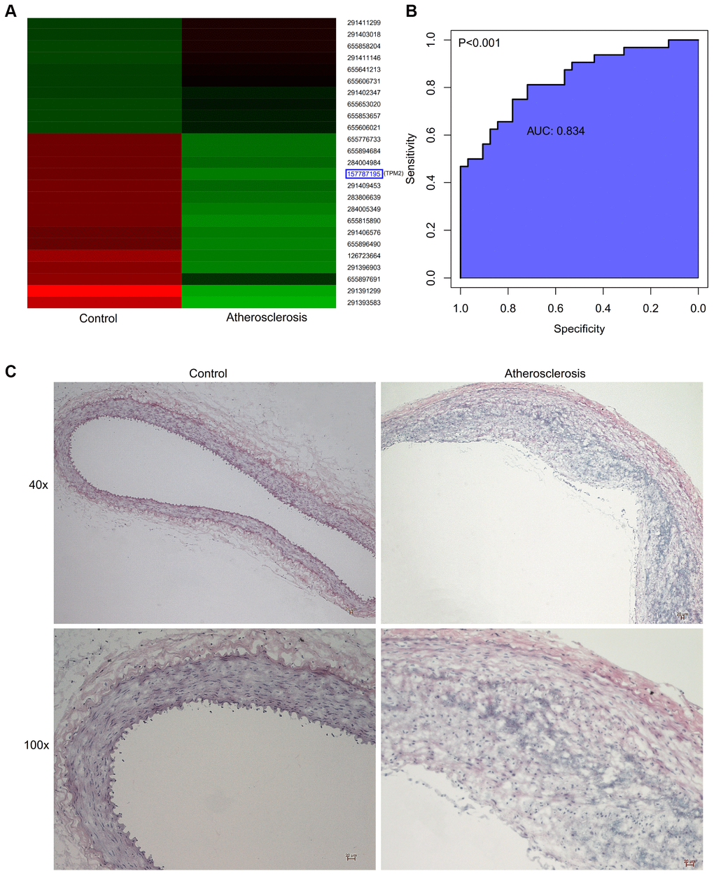 (A) Hierarchical clustering revealed the expression situation of DEGs between control and atherosclerotic samples in our private dataset. Upregulated genes are marked in red, downregulated genes are marked in green. The right legends represent Protein ID, where “157787195” represents TPM2. (B) The receiver operator characteristic curve, indicating that the expression level of TPM2 in the GSE43292 could predict atherosclerosis sensitively and specifically. (C) The pathological observation of artery of the control and atherosclerosis groups through the HE staining. (Gross appearance, 40x, 100x). HE: hematoxylin-eosin.