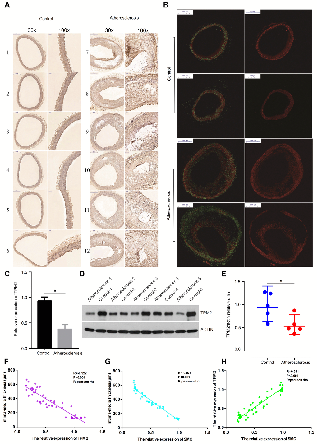 (A) The detection of SMC of the artery wall by immunohistochemical staining with anti-SMC monoclonal antibody. (Gross appearance, 30x, 100x). (B) The detection of SMC content of the artery wall by immunofluorescence assay. (Gross appearance, 30x). (C) Relative expression of TPM2 by RT-qPCR analysis. *pD) Western blotting expression of TPM2 in the control (Con) and atherosclerosis (AS) groups. (E) Quantitative comparison of TPM2 expression between the two groups. (F) The linear correlation between intima-media thickness and the relative expression of TPM2. (G) The linear correlation between intima-media thickness and the relative expression of SMC. (H) The linear correlation between the relative expression of TPM2 and the relative expression of SMC. SMC: smooth muscle cell.