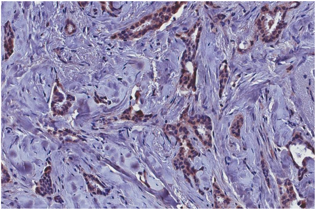 MMTVels-positive infiltrating breast carcinoma cells positive for p-14 protein with immunohistochemical analysis. MMTVels: MMTV env-like sequence.