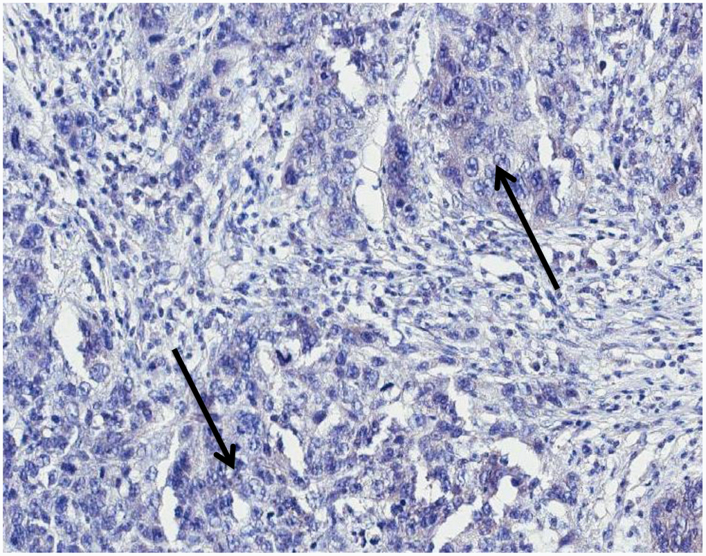 MMTVels negative infiltrating breast carcinoma cells negative for p-14 protein with immunohistochemical analysis (arrows: groups of cancer cells). MMTVels: MMTV env-like sequence.