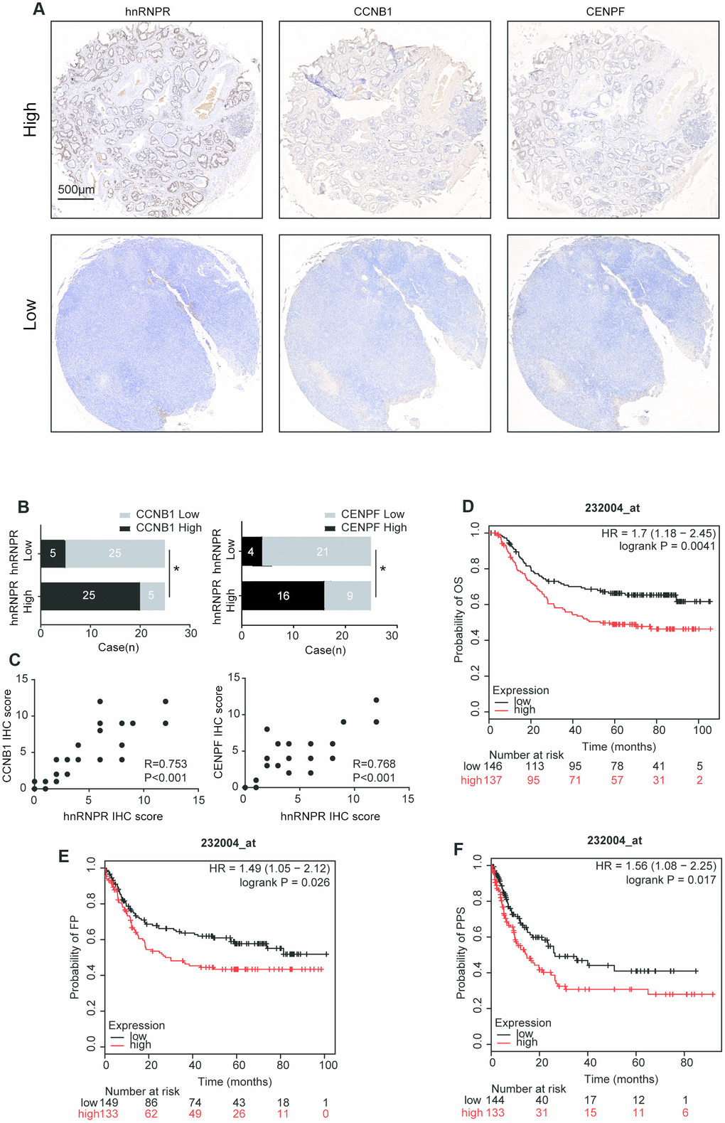 hnRNPR expression in the clinical samples. (A) Two representative images showing low or high expression of hnRNPR, CCNB1, and CENPF in human GC tissues. Scale bars 500μm. (B) Human gastric cancer tissues were used for hnRNPR and CCNB1/CENPF staining by IHC and quantitated. Chi-square test was used to analyze the correlation between HnRNPR and CCNB1/CENPF. PC) Association between IHC score of hnRNPR and CCNB1/CENPF expression. (D–F) Kaplan Meier curves of OS (overall survival), FP (first progression), and PPS (post-progression survival) in a cohort of gastric cancer patients stratified by hnRNPR expression.