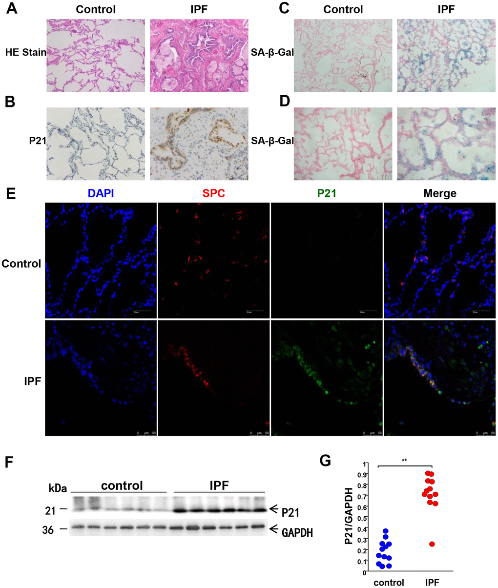 Aging-related markers are significantly overexpressed in the lung tissues of IPF patients. Human lung tissues of IPF (n = 12) and age-matched normal lung tissues (n = 12) were analyzed. (A) Representative images of HE staining of lung tissues (original magnification, 100×). (B) Representative images of the aging-related marker, P21WAF1, via IHC staining of lung tissues (original magnification, 100× in control and 200× in IPF). (C) Representative results of SA-β-Gal staining of lung tissues (original magnification, 100×). (D) Enlarged images of SA-β-Gal staining (200×). (E) Immunofluorescence staining of SP-C (an AEC2-specific marker, red) and P21WAF1(green) was conducted to confirm senescent marker expression in AECs (original magnification, 400×). (F, G) P21WAF1 senescent marker in lung tissues was measured by western blotting. Each dot represents an individual lung tissue. **p 