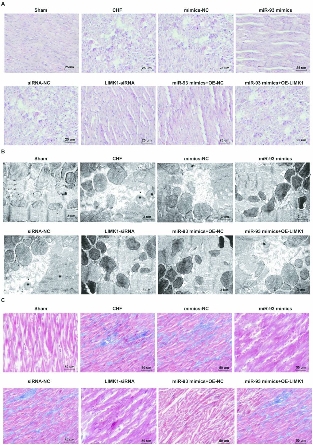Myocardial histopathological changes in rats were inhibited by up-regulation of miR-93 or downregulation of LIMK1. (A) HE staining of myocardial tissues in each group (× 400, scale bar 25 μm); (B) Ultrastructure of cardiomyocytes in each group (× 3000, scale bar 3 μm); (C) Masson staining of myocardial tissues in each group (× 200, scale bar 50 μm).