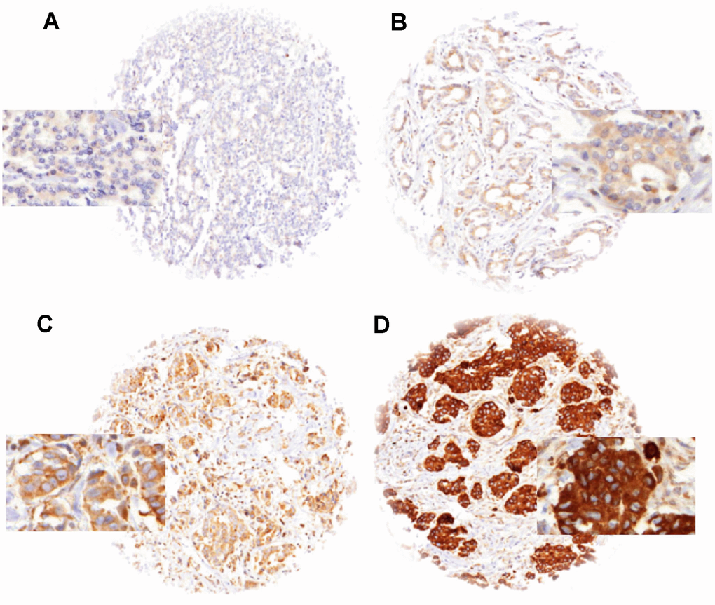 LPCAT1 staining in breast cancer with (A) negative, (B) weak, (C) moderate and (D) strong staining.
