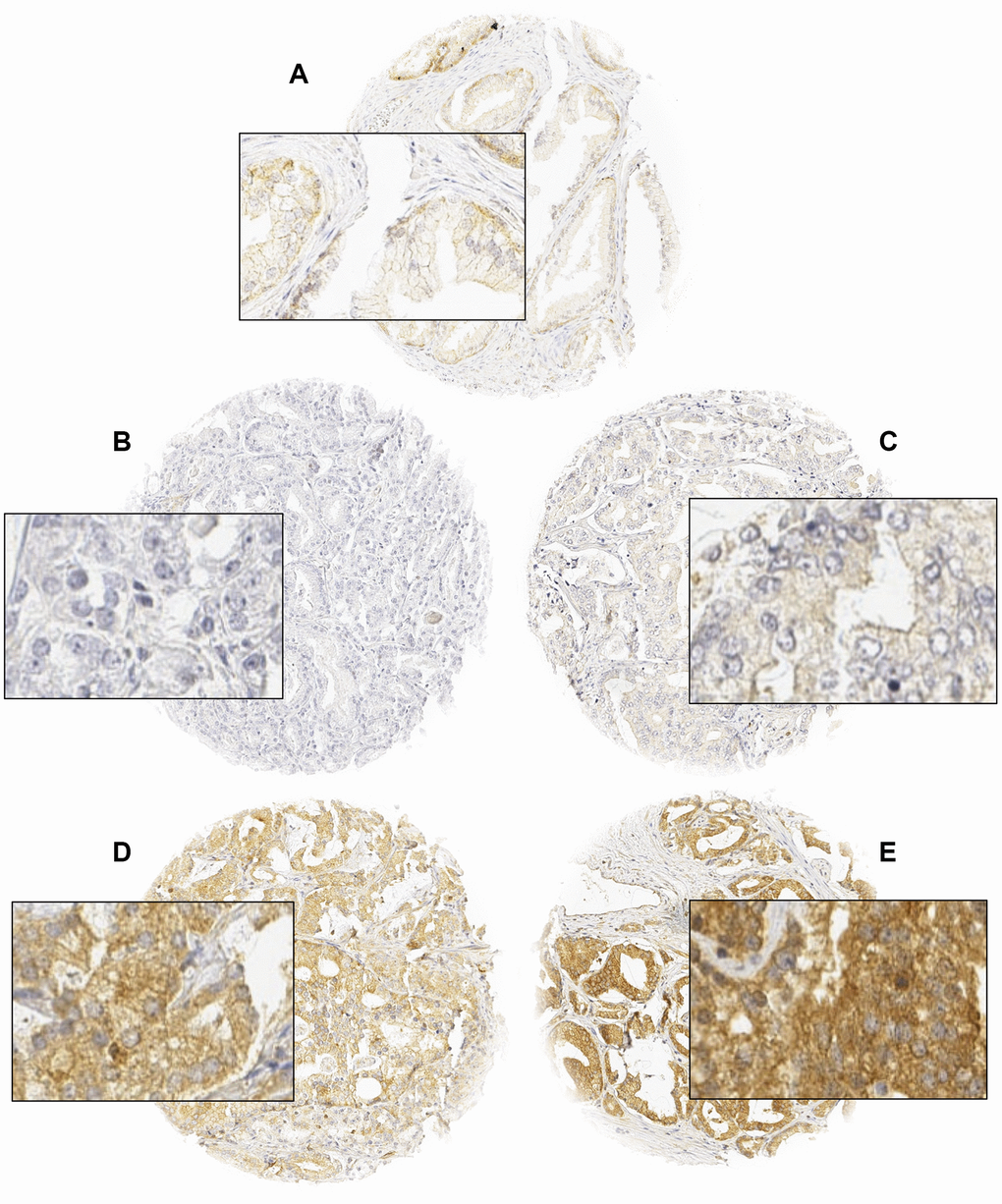 Representative images of normal (A) and cancerous glands (B–E) with negative (B), weak (C), moderate (D), and strong (E) ROCK1 staining. Spot size is 600 μm at 100 / 400x of originals.