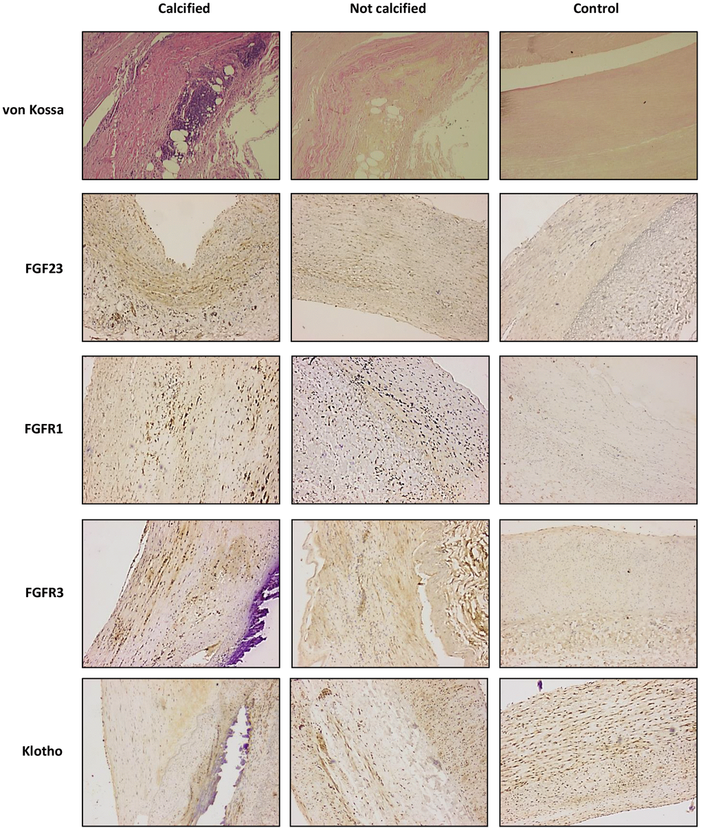 von Kossa and immunohistochemichal staining for FGF23, FGFR1, FGFR3 and Klotho, in sections of calcified and not calcified arteries of vascular surgery patients and in sections of control donors (magnification 4x).