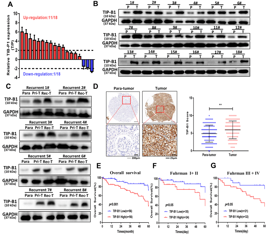 TIP-B1 is frequently upregulated in KIRC patients and correlates with poor prognosis. (A) RT-PCR analysis of TIP-B1 expression levels in 18 KIRC tissues and paired non-tumor kidney tissues. (B) Western blot analysis of TIP-B1 expression levels in 18 KIRC tissues and paired non-tumor kidney tissues. (C) Western blot analysis of TIP-B1expression levels in matched para-tumor, primary-tumor and recurrent tumor tissues from the same case. (D) Representative TMA images showing NR1B2 staining, and comparison of the IHC score between tumor and non-tumor kidney tissues. (E) Kaplan–Meier analysis of TMA patients with low versus high expression levels of TIP-B1. (F–G) Kaplan-Meier survival curve of TIP-B1 high-expressing and low-expressing patients was compared in Fuhrman stages I−II (F) and Fuhrman stages III−IV (G) subgroups.