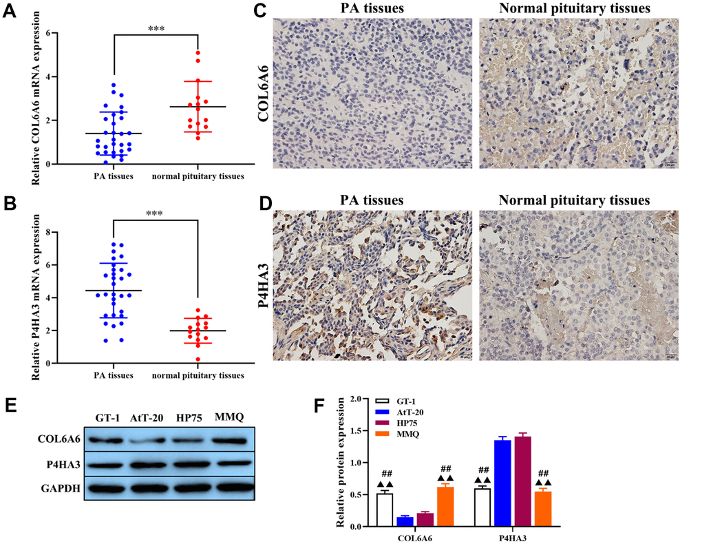 The expression of COL6A6 and P4HA3 in PA tissues and cell lines. (A and B) RT-qPCR was used to detect the expression of COL6A6 and P4HA3 in PA tissues and normal pituitary tissues; (C and D) Immunohistochemistry staining was applied to detect the expression of COL6A6 and P4HA3 in PA tissues and normal pituitary tissues; (E and F) Western blotting was used to evaluate the expression of COL6A6 and P4HA3 in PA cell lines. ***P##P▲▲P