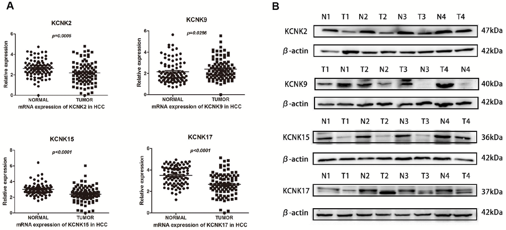 Differential expression of KCNK2/9/15/17 mRNA in surgically removed HCC tissues. KCNK9 mRNA levels are elevated while KCNK2, KCNK15, and KCNK17 mRNA levels are decreased in HCC tissues compared with normal tissues as measured by qRT-PCR (A). KCNK9 protein levels are increased while KCNK2/15/17 protein levels are decreased in HCC tissues compared to controls, as measured by Western Blot (B).