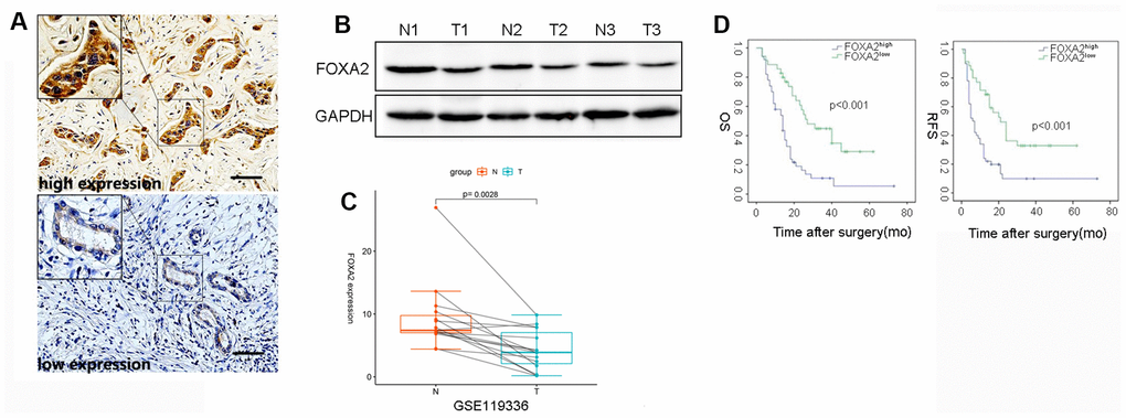 The correlation between intratumor FOXA2 expression and outcomes. (A) Representative immunostaining images of FOXA2 in ICC; (B) Protein level of FOXA2 in adjacent noncancerous tissue and tumor tissue. GAPDH was used as the loading control; (C) Paired analysis showed that FOXA2 expression was decreased in tumor samples. T: tumor tissue; N: adjacent normal tissue; (D) The overall survival (OS) and recurrence-free survival (RFS) rates of 85 ICC patients were compared between the low- and high-FOXA2 expression groups (P 