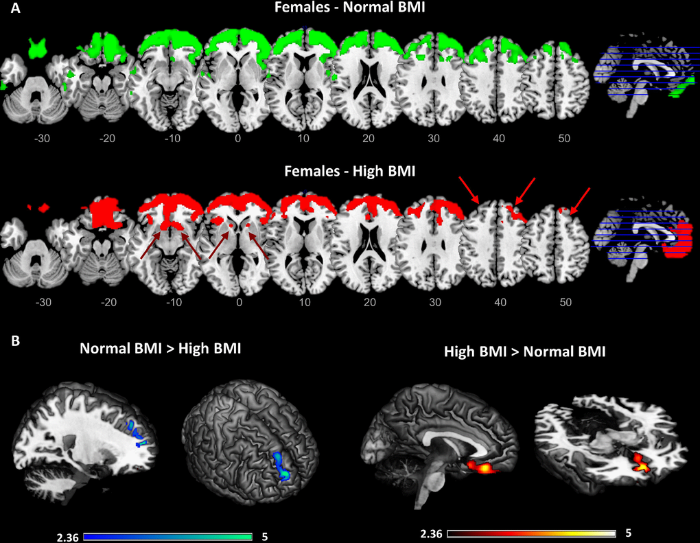 Results of the data-driven metabolic connectivity analysis in females. Figure shows results of the data-driven metabolic connectivity analysis, seeding from the BMI-related orbitofrontal cluster identified through whole-brain correlation analysis (see Figure 1 and text). The pattern of connectivity of the orbitofrontal cluster in females with normal BMI (upper panel) remarkably differs from the one observed in females with high BMI (lower panel) (A). In females with high BMI, loss of connectivity is evident between orbitofrontal cortex and high-order cortical regions, notably the dorsolateral prefrontal cortex (red arrows). Interconnections with reward-related brain circuits are also present (lacking in females with normal BMI), specifically involving the medial orbitofrontal cortex and nucleus accumbens (red arrows). Threshold for statistical significance was set at pB). A high-resolution MRI anatomical template in MRIcron was used for rendering.