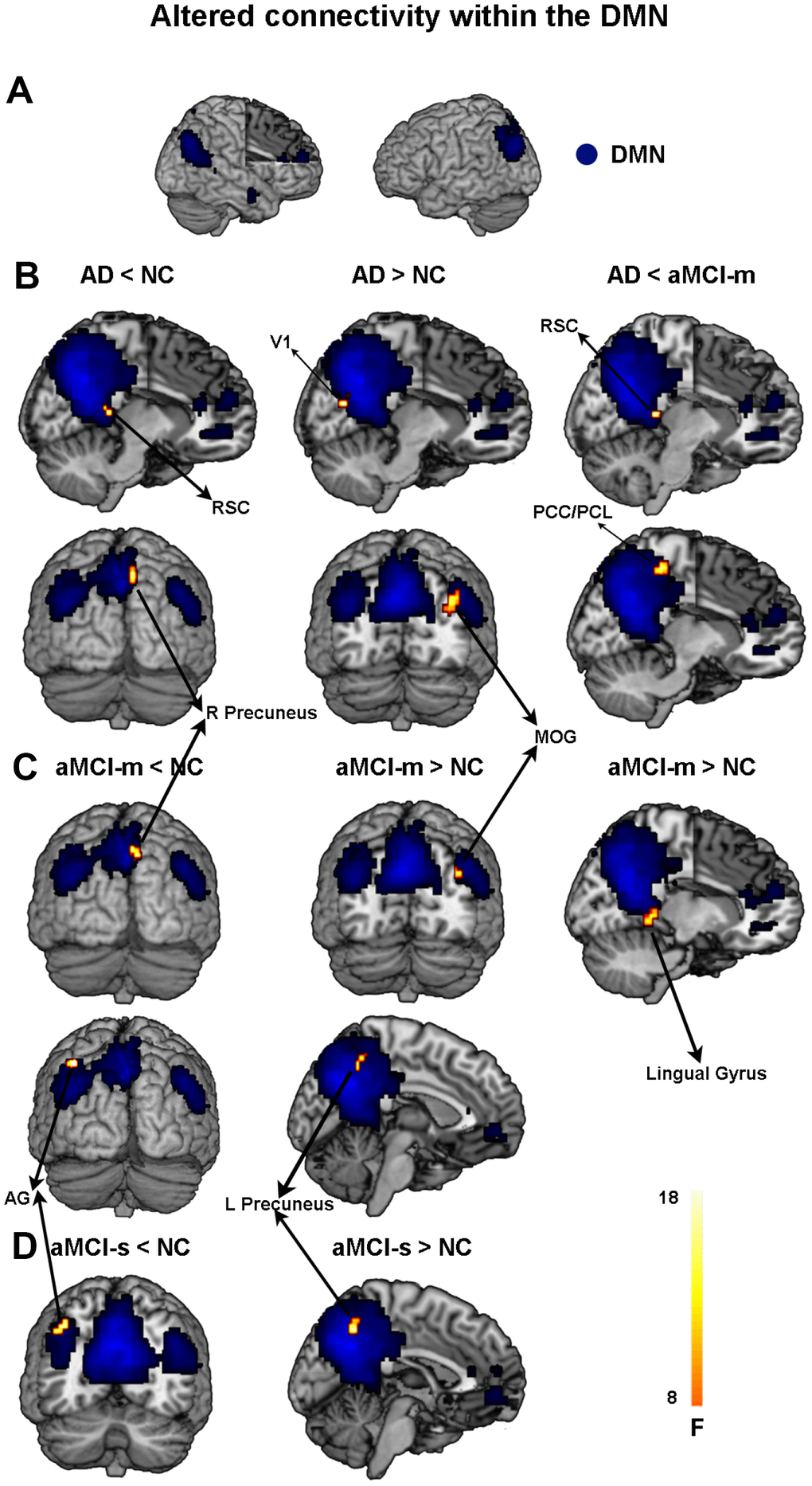 Altered functional connectivity within the DMN among the four groups. (A) Spatial distribution of the DMN (FWE correction). (B) Regions showing hypo- and hyperconnectivity within the DMN in the AD group; (C) Regions showing hypo- and hyperconnectivity within the DMN in the aMCI-m group; (D) Regions showing hypo- and hyperconnectivity within the DMN in the aMCI-s group. Abbreviations: DMN: default mode network; RSC: retrosplenial cortex; V1: primary visual cortex; MOG: middle occipital gyrus; PCC: posterior cingulate cortex; PCL: paracentral lobule; AG: angular gyrus; AD: Alzheimer's disease; aMCI-s: single-domain of amnestic mild cognitive impairment; aMCI-m: multiple-domain of amnestic mild cognitive impairment; NC: normal controls.