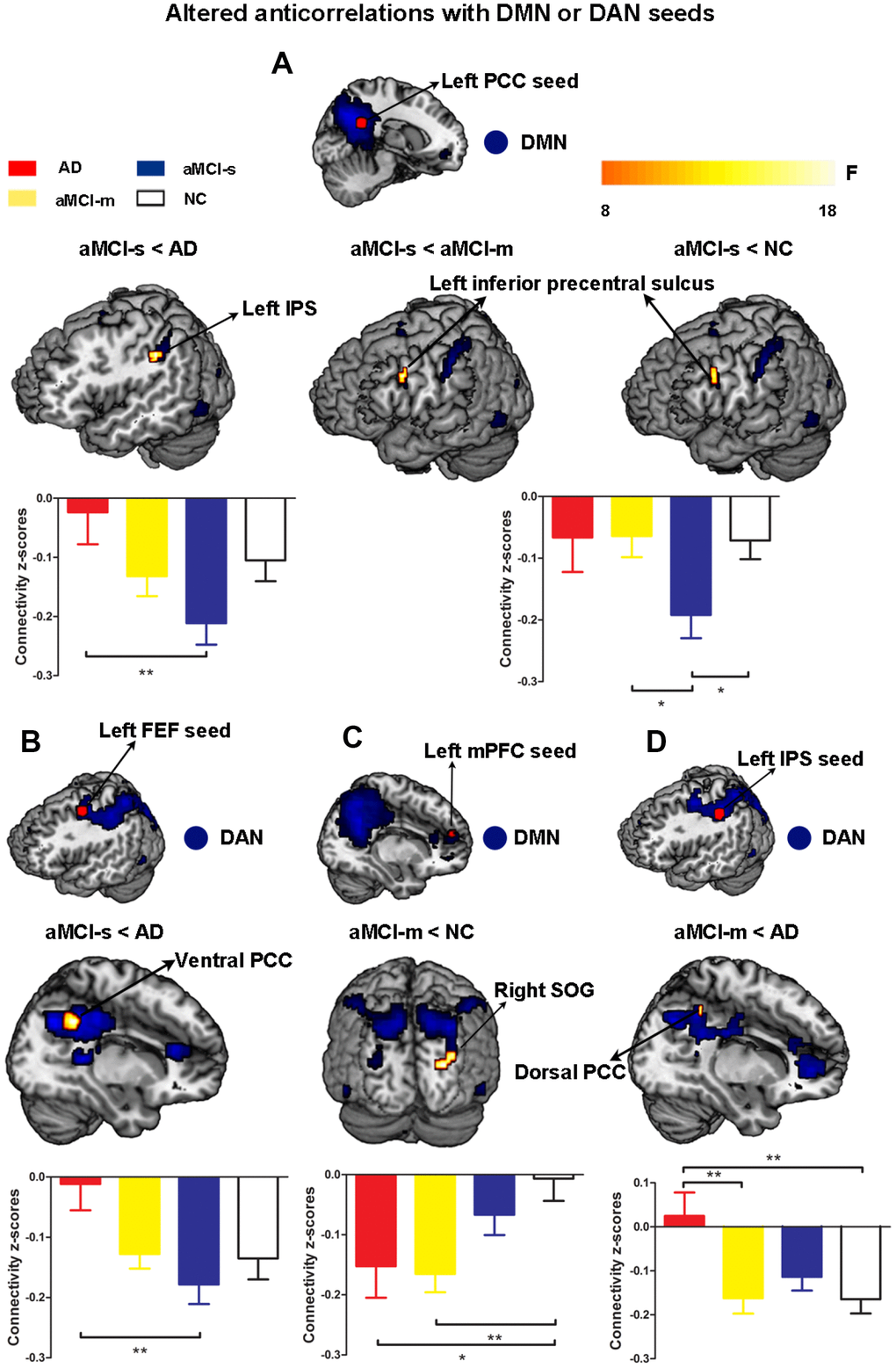 Altered anticorrelations between the DMN and DAN among the four groups. (A) Regions showing altered anticorrelations with the left PCC seed among the four groups; (B) Regions showing altered anticorrelations with the left FEF seed between the aMCI-s and AD groups; (C) Regions showing altered anticorrelations with the left mPFC seed between the aMCI-m and NC groups; (D) Regions showing altered anticorrelations with the left IPS seed between the aMCI-m and AD groups. Significant regions (shown in warm yellows) were overlaid on the main effect maps (shown in blue) which were corrected using a voxel threshold of FWE correction (P 