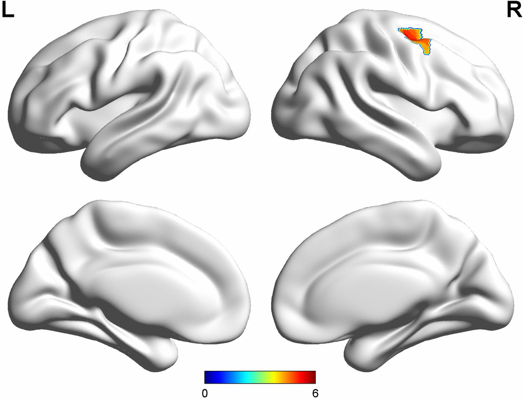 Comparison between early-onset PD patients with diphasic dyskinesia and HCs. Compared with HCs, early-onset PD patients with diphasic dyskinesia showed higher GM volumes in right precentral gyrus (Cluster size: 891 mm3). Correction for multiple comparisons (family-wise error rate (FWE), P 