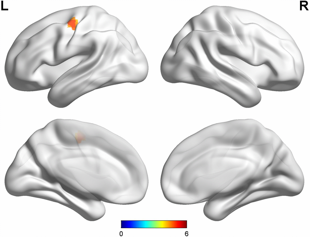 Comparison between late-onset PD patients with diphasic dyskinesia and late-onset PD patients without dyskinesia. Compared with late-onset PD patients without dyskinesia, late-onset PD patients with diphasic dyskinesia showed higher GM volumes in left precentral gyrus (Cluster size: 189 mm3). Correction for multiple comparisons (family-wise error rate (FWE), P 