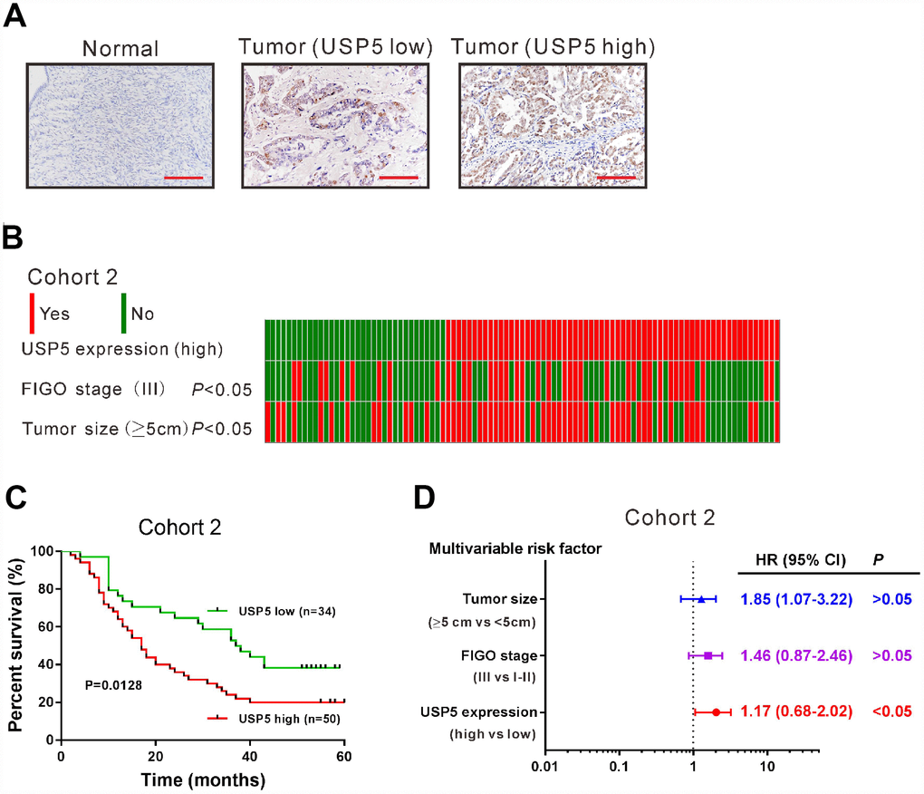 USP5 was up-regulated in ovarian cancer tissues and associated with overall survival. (A) Immunohistochemistry staining of USP5 in ovarian cancer and noncancerous tissues from cohort 2. Scale bar: 100 μm. The patients were divided into two groups USP5 low expression and USP5 high expression with a cut-off of 25% of positively-stained cancer cells. (B) Analysis of correlation between USP5 expression, FIGO stage and tumor size in cohort 2. (C) Kaplan-Meier survival analysis of ovarian cancer patients with high expression of USP5 and low expression of USP5 (log-rank analysis). (D) Multivariate regression analysis in cohort 2.