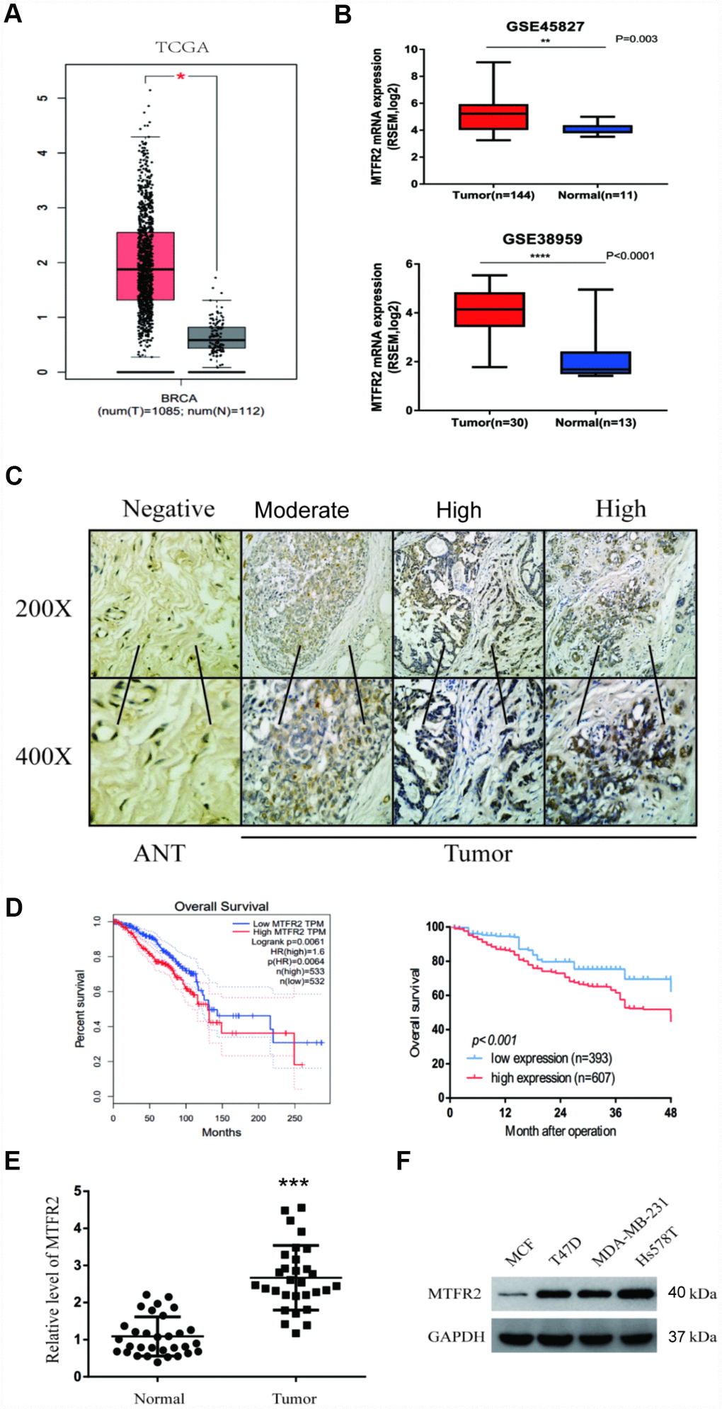 MTFR2 was upregulated in BC and negatively correlated with prognosis. (A) The relative level of MTFR2 in the TCGA database (Student’s two-tailed paired test * pB) The relative level of MTFR2 in the GSE45827 and GSE 38959 databases (Student’s two tailed paired test * pC) IHC staining of MTFR2 in BC samples. (D) The overall survival analysis of the TCGA database and our own database (Log rank test). (E) The relative level of MTFR2 in our own database (Student’s two tailed paired test *** pF) Western blot of MTFR2 in the BC cell line.