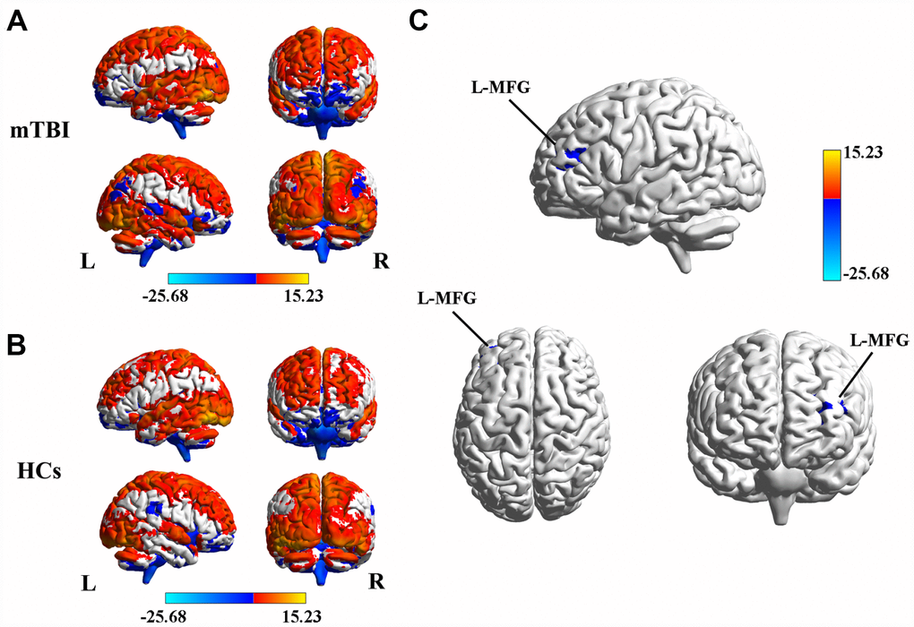 (A) Spatial distribution of the degree centrality (DC) in mTBI patients at the acute stage. (B) Spatial distribution of the DC in the healthy controls (HCs). (C) Significantly decreased DC within the left middle frontal gyrus (MFG) between acute mTBI patients and HCs. mTBI, mild traumatic brain injury; HCs, healthy controls.