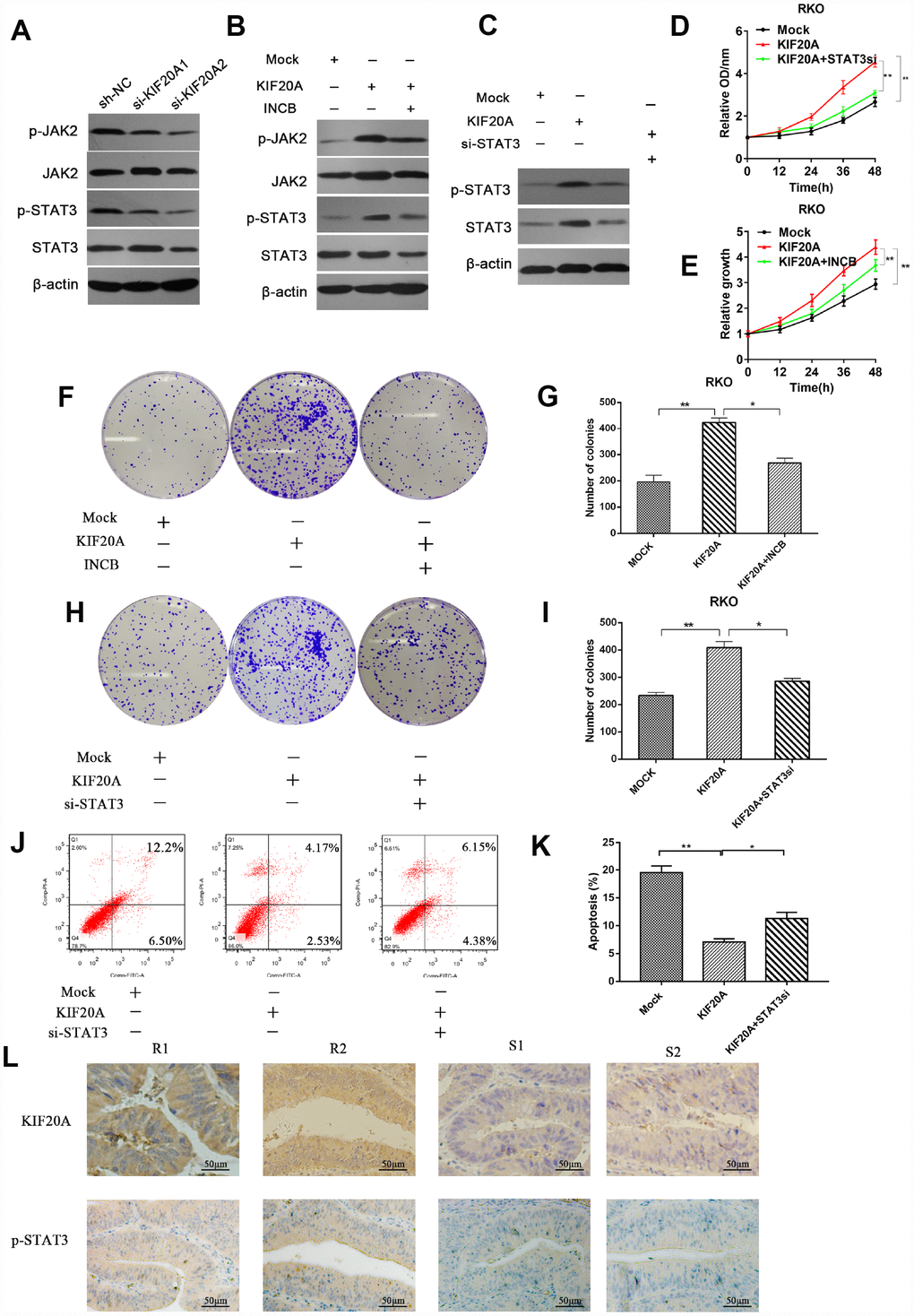 KIF20A mediates malignant behaviors in CRC via the JAK/STAT3 signaling pathway. (A) Phosphorylation of JAK and STAT3 in different transfected groups was determined by western blot analysis. (B) Western blot analysis of phosphorylation of JAK and STAT3 in different transfected groups with or without the administration of JAK inhibitor, INCB. (C) Western blot analysis of phosphorylation of JAK and STAT3 in different transfected groups with or without the silence of STAT3. (D, E) Relative growth rate of different transfected groups with or without the administration of INCB or silence of STAT3. The comparison was made at indicated times. (F–I) Colon formation assay of different transfected groups with or without the administration of INCB or silence of STAT3. (J–K) The apoptotic rates of different transfected groups with or without silence of STAT3 were measured by flow cytometry. (L) Immunohistochemical staining of KIF20A and p-STAT3 in an independent set of CRC tumor samples with good or poor responses to 5-FU and oxaliplatin therapy. Scale bar=50 μm. Data are presented as mean ± SEM. *P P 