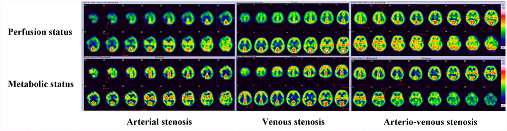 Perfusion and metabolic status of CAS, CVS and CAVS on SPECT. CAS and CAVS always has focal or unilateral reduced perfusion with elevated or reduced metabolic status. CVS displays with bilateral symmetrical perfusion reduction and metabolic status maintaining normal or elevation frequently.