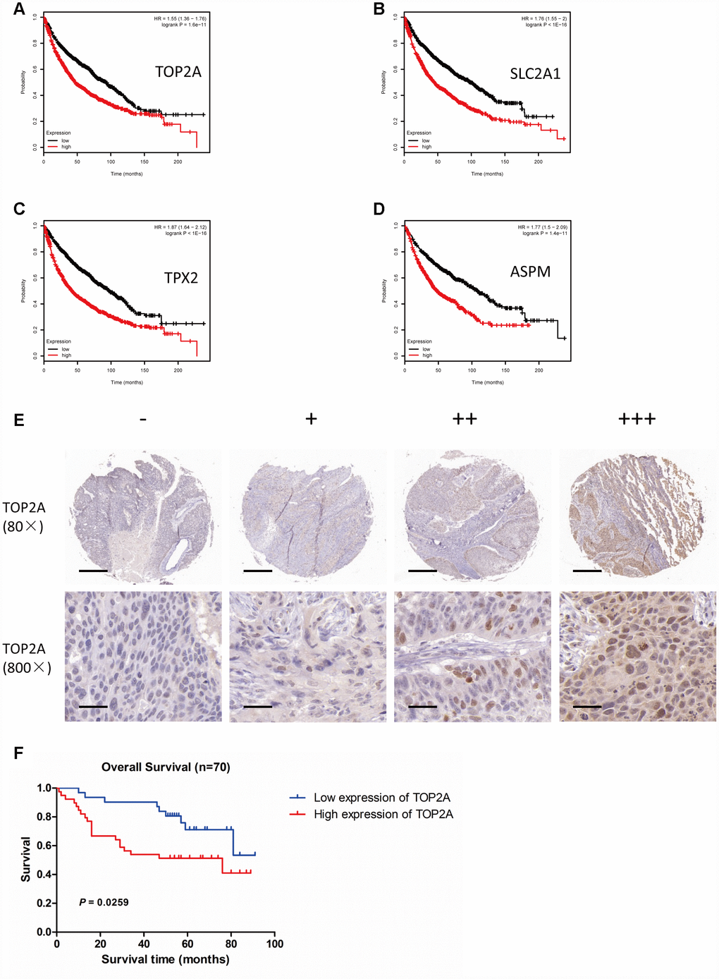 Association of TOP2A, SLC2A1, TPX2, and ASPM with overall survival in patients with lung cancer. Survival analyses were conducted using the Kaplan Meier plotter tool. (A) OS based on high vs low TOP2A expression (P = 1.6e-11). (B) OS based on high vs low SLC2A1 expression (P C) OS based on high vs low TPX2 expression (P D) OS based on high vs low ASPM expression (P = 1.4e-11). (E) IHC analysis of TOP2A expression in NSCLC (80X and 800X magnifications). (F) OS of NSCLC patients with high or low TOP2A protein expression (P = 0.0259).