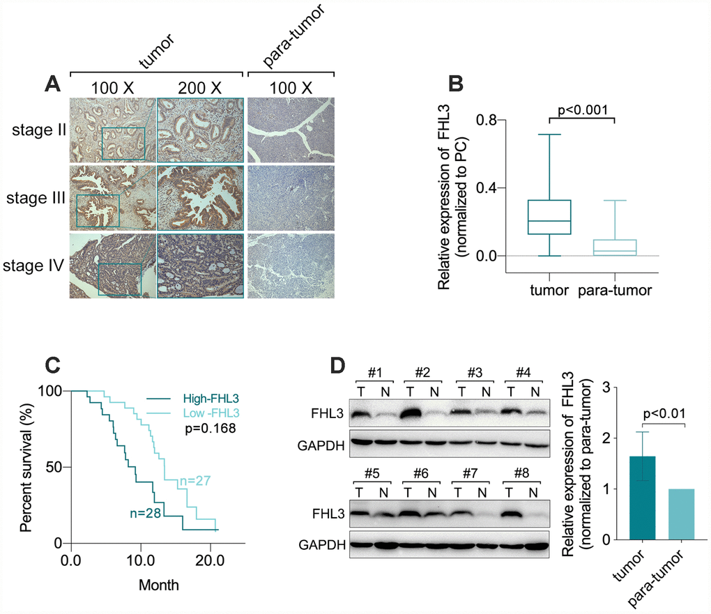 FHL3 referred to PDAC progression. (A and B) IHC staining and statistical analysis of FHL3 for sections from 55 matched different lesion stages tissues of PDAC and para-tumor normal area, which showed the higher expression level of FHL3 in PDAC, more than 3-fold, as compared with normal tissue, pC) Survival analysis via Kaplan-Meier analysis in 55 PDAC samples which showed higher expression level of FHL3 was accompanied with worse prognosis, p=0.0168. (D) WB assay of 8 matched fresh frozen PDAC samples, which showed higher expression level of FHL3 in PDAC tissues more than 1.5-fold, p