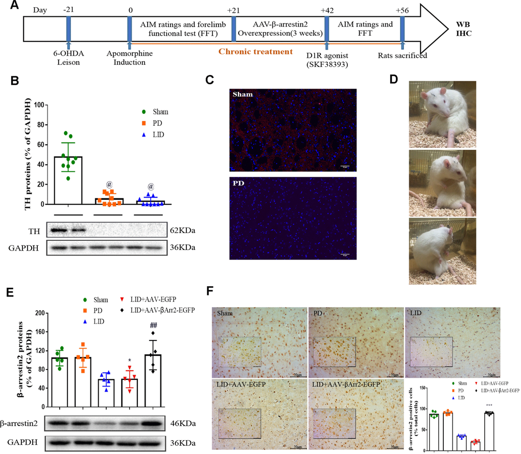 Recombinant adeno-associated virus (AAV)-induced β-arrestin2 overexpression (β-arrestin2+/+) in the unilateral 6-OHDA-lesioned striatum of SD rats. (A) Schedule of experiment in β-arrestin2+/+ rats. At the beginning of the studies, the rats (n=56) was injected unilaterally with 6-OHDA in the right medial forebrain bundle (MFB). After three weeks, lesion efficacy was assessed by the rotations after the use of apomorphine for the following induction of L-dopa-induced dyskinesia (LID). The β-arrestin2 overexpression rat models on the base of LID were constructed immediately and followed by intraperitoneal injection of D1R agonist (SKF38393) once a day. All groups of rats except PD and sham were injected with L-dopa (15 mg/kg, i.p.) plus benserazide (3.75 mg/kg, i.p.). Additionally, rats in the PD group and sham group were treated physiological saline. After the last drug administration, all rats were sacrificed in two hours and fetched the lesioned corpus striatum for the following WB, IHC and IFC. (B) Tyrosine hydroxylase (TH) protein levels was markedly decreased by nearly 90% in the PD or LID rats compared with sham group by western blot (n=4 for each group). (C) Fluorescence slice of coronal plane from striatum of rats between sham and PD groups stained with TH (n=4 for each group). Scale bar represents 100 um. (D) Still images showing L-dopa-induced dyskinesia in a parkinsonian rat. (E) AAV-β-arrestin2 expression (β-arrestin2+/+) relative to GAPDH level in five groups by WB in the lesioned striatum (n=4 for each group). The experiments for Figure 1B and Figure 1E were performed together with the same Sham, PD and LID tissues for western blot; (F) AAV-β-arrestin2 expression (β-arrestin2+/+) in five groups by IHC in the lesioned striatum (n=4 for each group). Scale bar represents 100 um. The experiments for Figure 1C and Figure 1F were performed together with the same Sham and PD for immunohistochemistry. @ P  0.05 vs sham group; ***p
