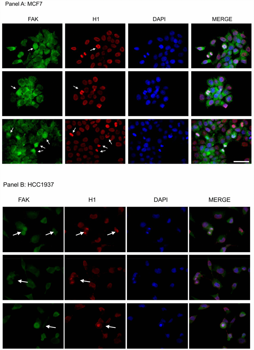 Assessment of FAK and H1 localization in MCF7 and HCC1937 cell lines. Immunofluorescence analysis of an asynchronous MCF7 cell population stained with antibodies against FAK (green) and H1 (red). Images of the cells captured at different stages of mitosis revealed FAK co-localization with H1 (white arrows). The nuclei were counterstained with DAPI (blue) and merge is also shown. Scale bar: 50 μm. The images are representative of three independent biological replicates.