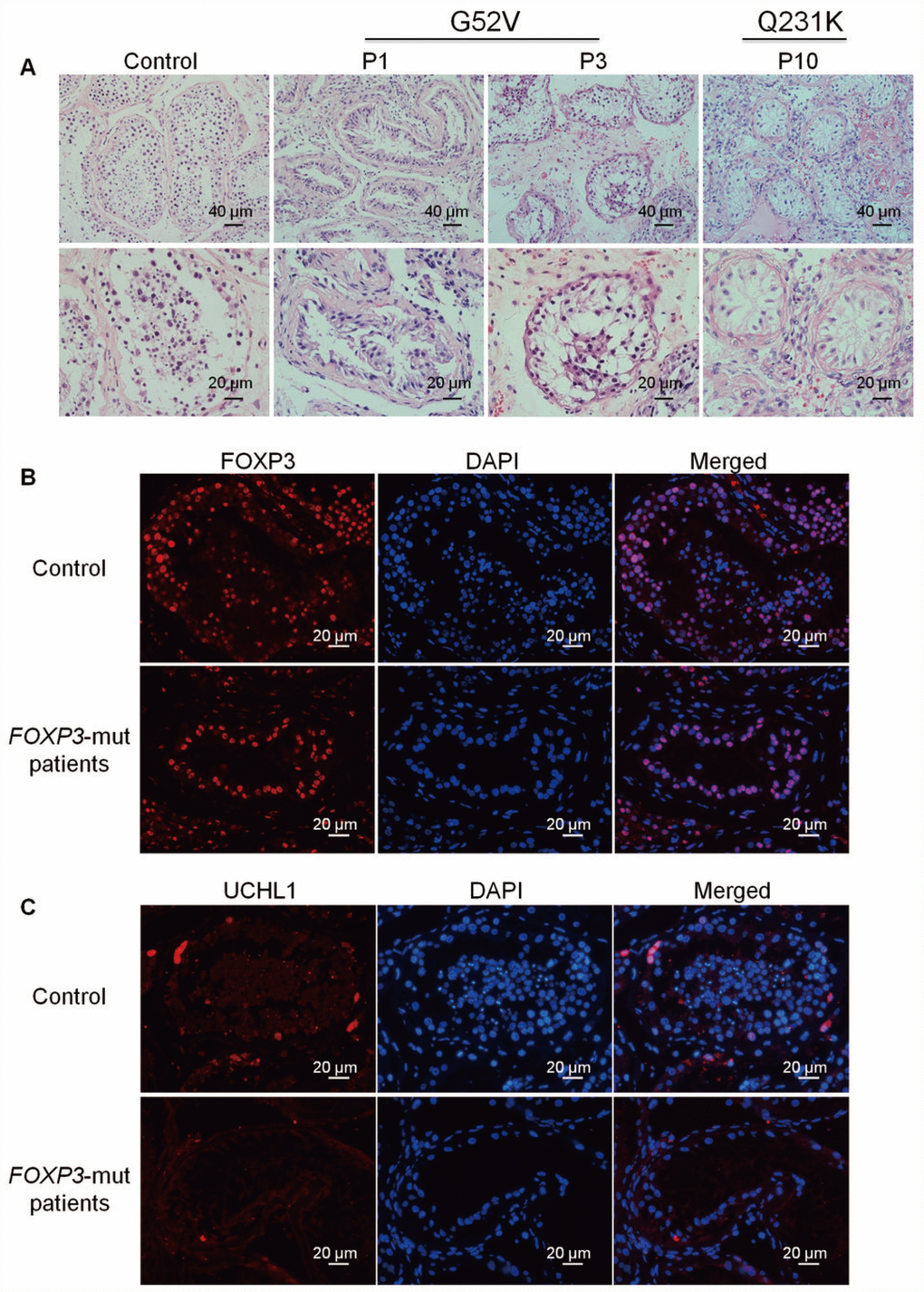 Morphology and phenotype of FOXP3-mut NOA patients and OA controls. (A) H&E staining revealed that seminiferous tubule diameter was reduced and spermatogenesis was arrested in FOXP3-mut NOA patients. Scale bars = 40 μm and 20 μm, respectively. (B-C) Immunohistochemical staining demonstrated the expression of FOXP3 protein (B) and UCHL1 protein (C) in FOXP3-mut NOA patients (low panels) and OA controls (upper panels). Experiments were repeated for at least three times. Scale bars = 20 μm.