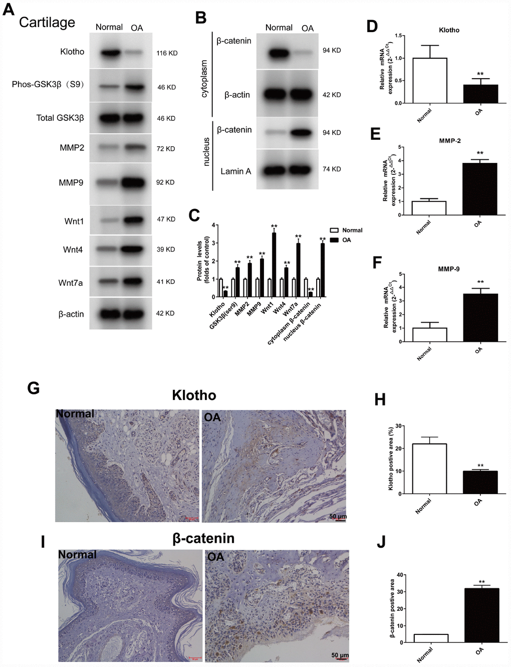 Up-regulation of Wnt signaling and down-regulation of Klotho in the joint after injury. ACLT surgery was used to induce OA in adult male C57/6J mice. Expression of Klotho, Phos-GSK3β (S9), GSK3β, MMP2, MMP9, Wnt1, Wnt4, Wnt7a and β-catenin (cytoplasm/nucleus) in the mouse cartilage tissue. (A) Expression change of Klotho, Phos-GSK3β (S9), GSK3β, MMP2, MMP9, Wnt1, Wnt4, Wnt7a, and (B) β-catenin in the cytoplasm and nucleus by Western Blot after modeling. (C) Protein levels of Klotho, Phos-GSK3β (S9), GSK3β, MMP2, MMP9, Wnt1, Wnt4, Wnt7a and β-catenin were detected by western blotting. Protein/β-actin and Protein/Lamin A were used to demonstrate the protein fold changes. (D) Klotho mRNA expression was assessed in the cartilage at 12 weeks after ACLT or control. (F) The expression of matrix-degrading enzyme genes, MMP-2 (E), MMP-9 (F) were evaluated by Real-Time PCR. (G–J) The expression of Klotho protein and β-catenin protein in the control group and OA group were compared by immunohistochemistry,. Scale bar, 50 mm. Data are the mean ±SD, n=8 mice. *P 