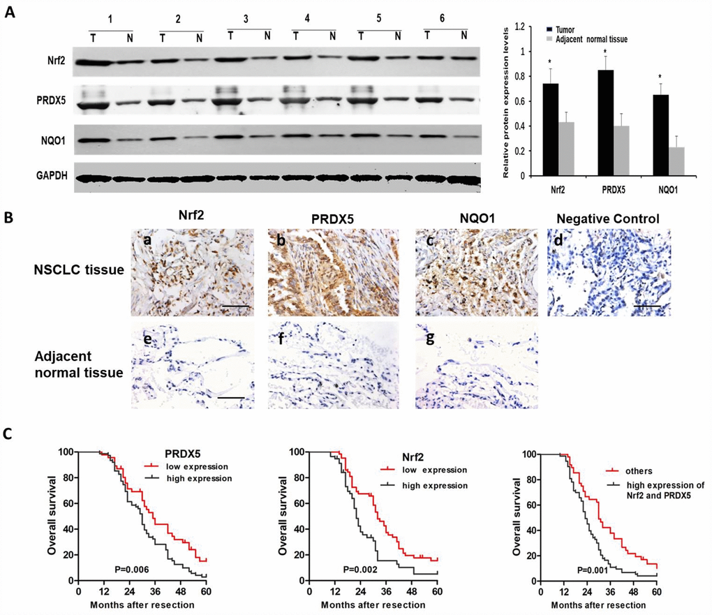 The protein expressions of Nrf2, PRDX5 and NQO1 in NSCLC specimens. (A) The Nrf2, PRDX5 and NQO1 expressions in 26 NSCLC and the adjacent normal tissues by western blot analysis. The representative western blot results in 6 cases are shown. GAPDH was used as a control for protein load and integrity. The bar chart demonstrated the ratio of Nrf2, PRDX5 and NQO1 expression to GAPDH between tumor and non-tumor tissues for the above by densitometry. *,#P #P B) Immunohistochemical analysis of Nrf2, PRDX5 and NQO1 in NSCLC tissues (a–d) and the adjacent normal tissues (e–g). Scale bar, 100 μm. (C) Cumulative survival curves according to Nrf2 and PRDX5 expression in 121 patients with NSCLC. Left, overall survival curves of low PRDX5 expression group vs high PRDX5 expression group (the choosing relative level of 2.323 as the optimal cut-off point of PRDX5). Middle, overall survival curves of low Nrf2 expression group vs high Nrf2 expression group (the choosing relative level of 2.825 as the optimal cut-off point of Nrf2). Right, overall survival curves of high Nrf2/PRDX5 expression group vs the other group.