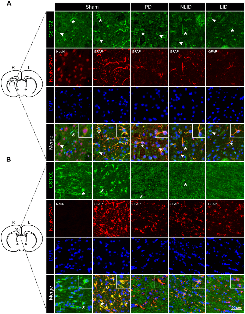 Decreased expression of GSTO2 in neurons and astrocytes of the brain in PD and LID rats. (A, B) Double immunofluorescence labeling of GSTO2 and neuron or astrocyte markers in the striatum (A) and corpus callosum (cc) (B) of PD and LID rats and their corresponding controls (n = 3). A single cell is shown in the insets. Arrows and asterisks indicate neurons and astrocytes, respectively, expressing GSTO2.