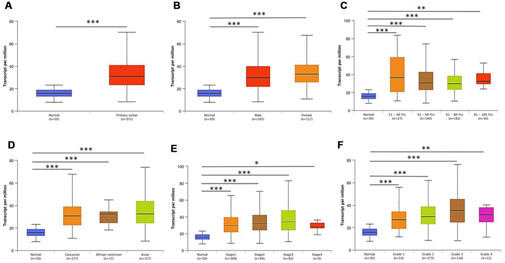 PRPF3 transcription in subgroups of patients with HCC, stratified based on gender, age and other criteria (UALCAN). Box-whisker plots showing the expression of PRPF3 in sub groups of LIHC samples. (A) Boxplot showing relative expression of PRPF3 in normal and LIHC samples. (B) Boxplot showing relative expression of PRPF3 in normal individuals of either gender and male or female LIHC patients, respectively. (C) Boxplot showing relative expression of PRPF3 in normal individuals of any age or in LIHC patients aged 21-40, 41-60, 61-80, or 81-100 yr. (D) Boxplot showing relative expression of PRPF3 in normal, African American, Caucasian and Asian LIHC patients. (E) Boxplot showing relative expression of PRPF3 in normal individuals or in LIHC patients in stages 1, 2, 3 or 4. (F) Boxplot showing relative expression of PRPF3 in normal individuals or LIHC patients with grade 1, 2, 3 or 4 tumors. The central mark is the median; the edges of the box are the 25th and 75th percentiles. The t-test was used to estimate the significance of difference in gene expression levels between groups. *, p p p 