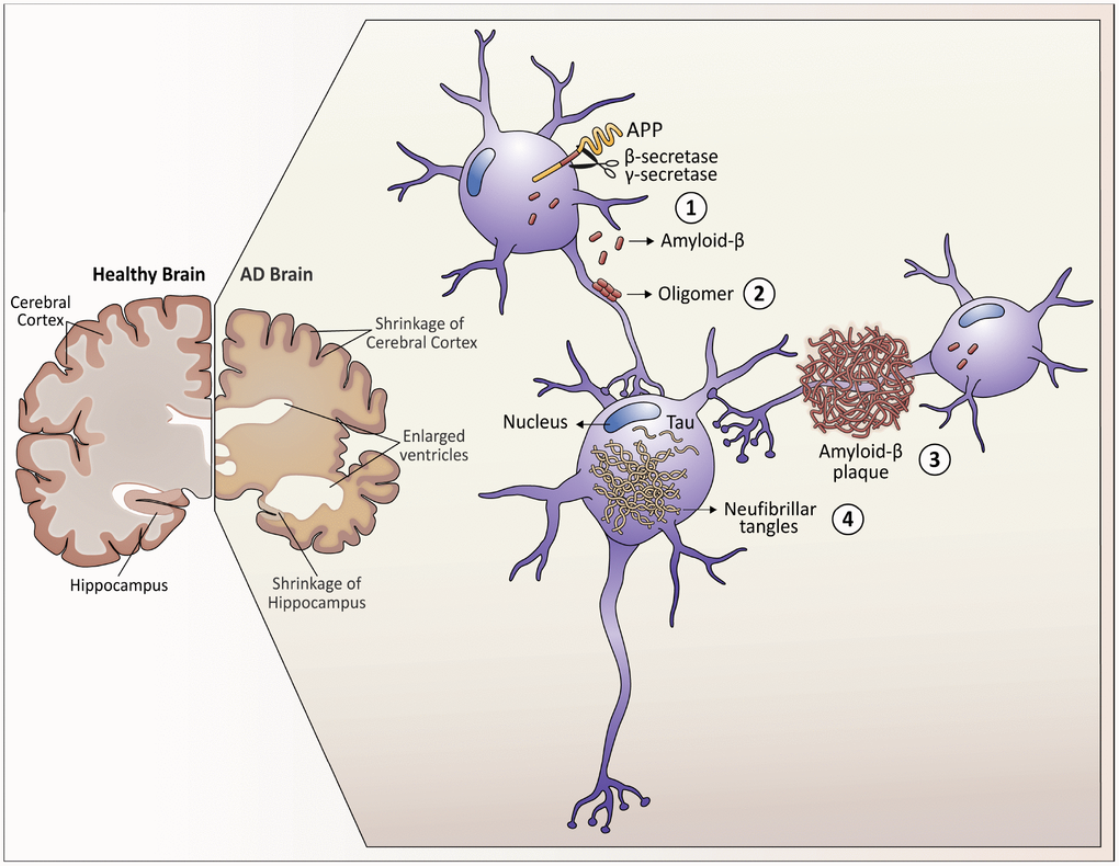 Neuropathological hallmarks that characterize Alzheimer’s disease. As Alzheimer's disease progresses, the brain tissue shrinks, the volume of the ventricle, which contains cerebrospinal fluid, increases markedly. At the molecular level: 1. Amyloid-β peptides are produced by the cleavage of the amyloid precursor protein (APP) in the membrane of the neurons. 2. In the space between the neurons, amyloid-β forms oligomers that are thought to disrupt the function of the synapses and act in receptors present in the neuron plasma membrane. 3. The fibrils of the amyloid-β oligomers are added in plaques, which interfere with the function of the neurons. 4. Tau hyperphosphorylation causes neurofibrillary tangles within neurons, displacing intracellular organelles and disrupting vesicular transport.