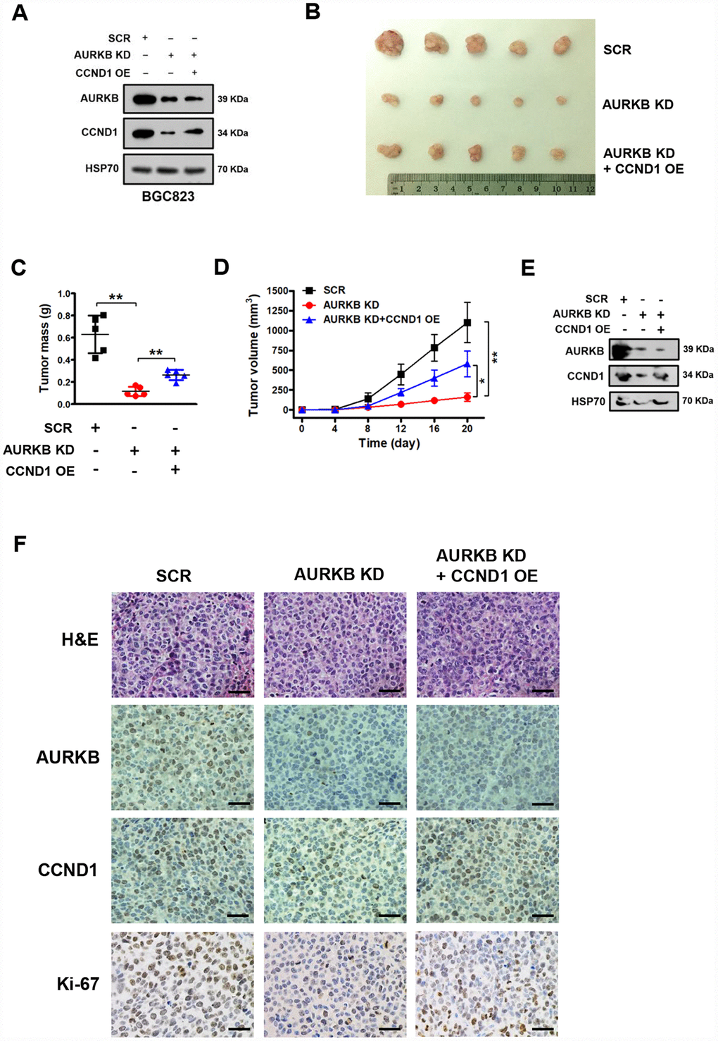 AURKB promotes gastric cancer cell growth by regulating CCND1 in vivo. (A) Western blot analysis of the protein levels of AURKB, CCND1 and HSP70 in stable BGC823 cell lines. HSP70 was used as the endogenous loading control. (B) Photograph of xenograft tumors excised from mice in the scrambled (SCR) control, AURKB KD and AURKB KD + CCND1 OE groups. (C) Tumor masses of xenograft tumors excised from mice in the SCR control, AURKB KD and AURKB KD + CCND1 OE groups. Data are presented as the means ± SDs; **, P D) Tumor volumes were examined on the indicated days. Data are presented as the means ± SDs; *, P E) Western blotting analysis of AURKB and CCND1 expression in xenograft tumors excised from mice in the SCR control, AURKB KD and AURKB KD + CCND1 OE groups. HSP70 was used as the endogenous loading control. (F) Hematoxylin and eosin (H&E) staining and IHC staining of AURKB, CCND1 and Ki-67 in xenograft tumors excised from mice in the SCR control, AURKB KD and AURKB KD + CCND1 OE groups.