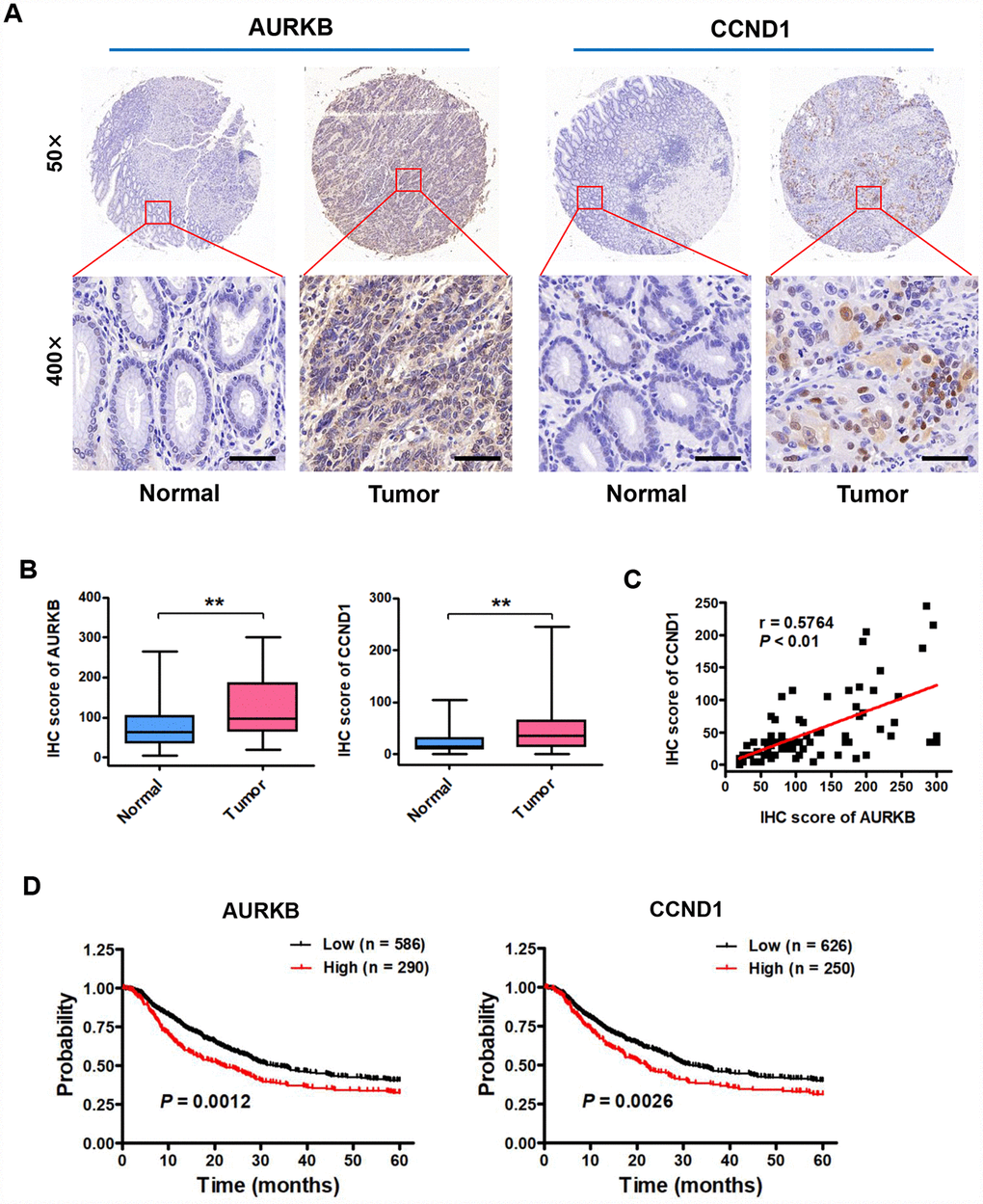 Expression of AURKB and CCND1 is upregulated in gastric cancer tissues, and these expression levels are associated with poor prognosis in gastric cancer patients. (A) Representative images of immunohistochemical (IHC) staining of AURKB and CCND1 in human gastric cancer tissues and matched normal tissues (n = 80). (B) Total IHC score for AURKB and CCND1 in human gastric cancer tissues (Tumor) and matched normal tissues (Normal). **P C) The correlation between AURKB and CCND1 expression was evaluated using Pearson correlation analysis (n = 80; r = 0.5764; P D) Analysis of data from the Kaplan-Meier plotter database suggested that high expression levels of AURKB (left panel; P = 0.0012) and CCND1 (right panel; P = 0.0026) are negatively correlated with 5-year overall survival in gastric cancer patients.
