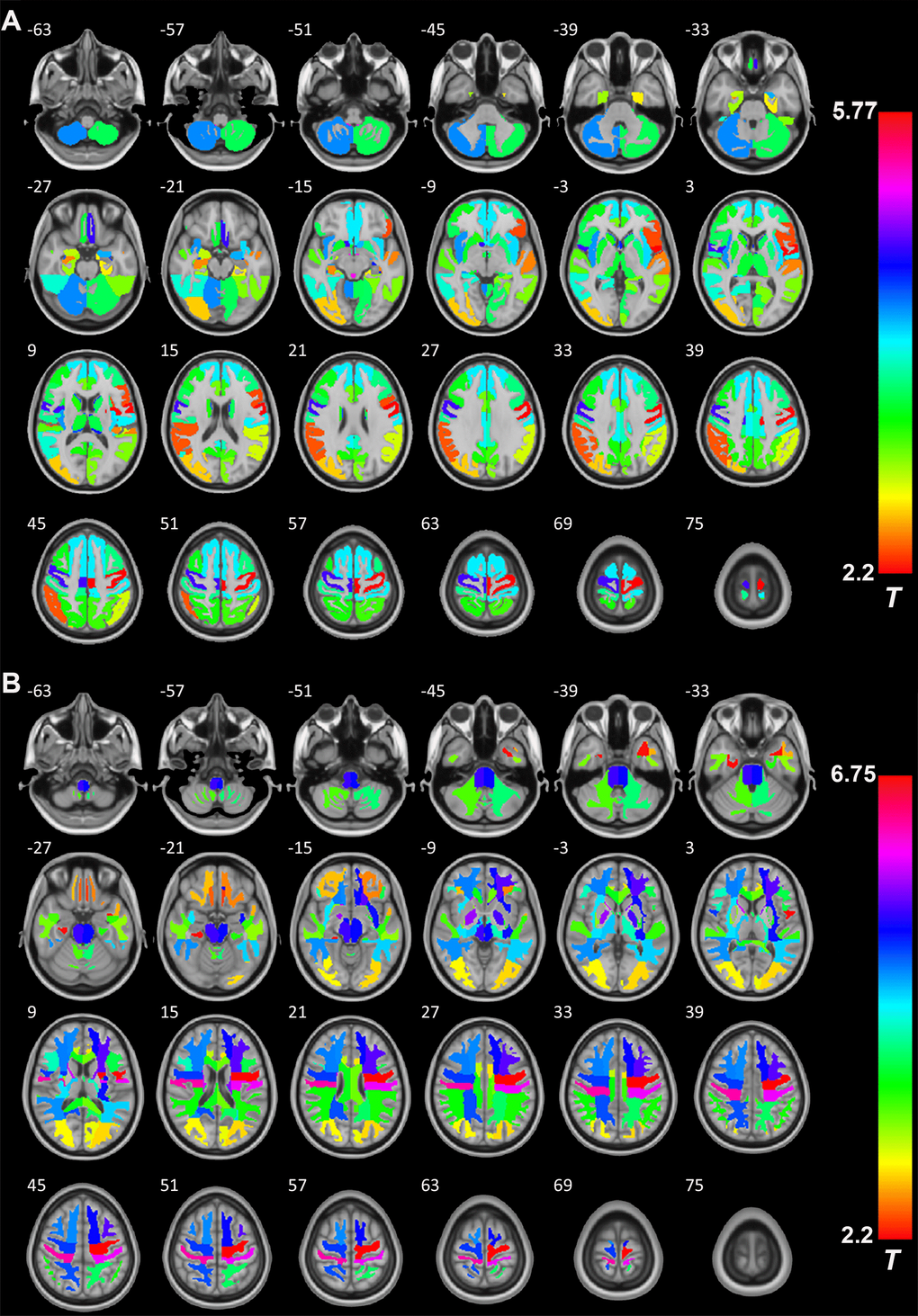 The role of GH/IGF-1 in the GMV and WMV of brain regions. (A) RBM analysis showing the increased GMV of 54 brain regions (Supplementary Table 1, from a total of 68 brain regions, Hammers' atlas) in patients with excess GH/IGF-1 production compared to that in HCs. (B) RBM analysis showing the white matter volume (WMV) of 54 brain regions (Supplementary Table 1, from a total of 68 brain regions, Hammers' atlas) increase in patients with excess GH/IGF-1 production compared to HCs. Significance was determined by uncorrected p 