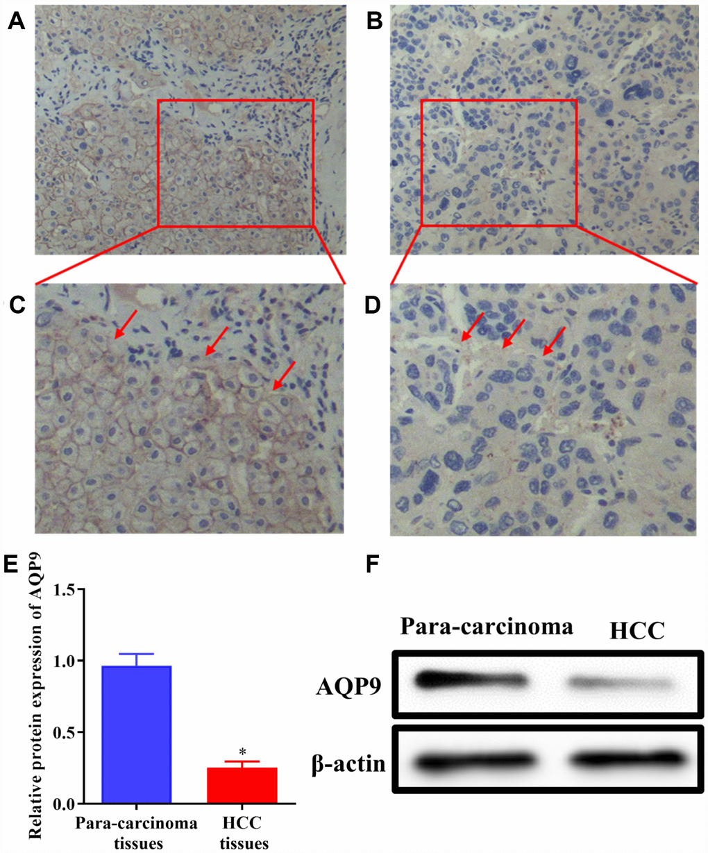 The expression of AQP9 was reduced in HCC samples. (A–D) The levels of AQP9 were examined in HCC and paired non-tumor tissues by immunohistochemistry analysis (magnificationx200 and x400). (E and F) The levels of AQP9 were also examined using western blotting. The results were represented as mean ± SD. P
