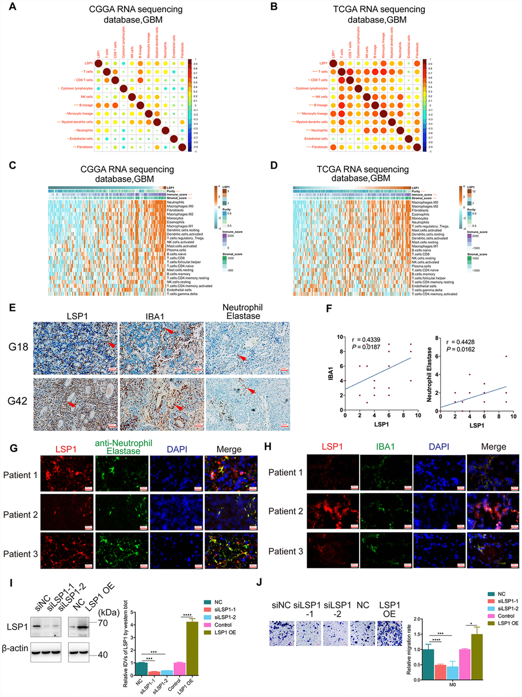 High LSP1 expression contributed to the immunosuppressive microenvironment in GBM. (A and B) The correlation analysis of LSP1 expression and non-tumor immune and stromal cell populations in GBM by MCP-counter (A, CGGA RNA sequencing dataset, n = 138; B, TCGA RNA sequencing dataset, n = 155; with Pearson correlation analysis). (C and D) Association of LSP1 expression with tumor purity, immune and stromal score, and twenty-four immune cell populations in GBM microenvironment by GSVA. (C, CGGA RNA sequencing dataset, n = 138; D, TCGA RNA sequencing dataset, n = 155; with Pearson correlation analysis). (E and F) Representative IHC images (E, 200X, scale bar = 50μm) and analysis (F) verifying LSP1 expression correlated with macrophages and neutrophil in 29 cases of GBM samples (macrophage: r = 0.4339, P = 0.0187; neutrophil: r = 0.4428, P = 0.0162; n = 15; with Pearson correlation analysis). (G) Representative IF images of LSP1 (red), Neutrophil Elastase (green), and DAPI (blue) staining in clinical GBM samples (n = 3) (200X, scale bar = 50μm). (H) Representative IF images of LSP1 (red), IBA1 (green), and DAPI (blue) staining in clinical GBM samples (n = 3) (200X, scale bar = 50μm). (I) Representative western blot image (left panel) and analysis (right panel) of LSP1 expression in M0 macrophages induced from THP-1 cells. (J) Transwell assay showing LSP1 knockdown inhibit the migration of M0 macrophages, and LSP1 overexpression enhanced their migration. CGGA, Chinese Glioma Genome Atlas; TCGA, The Cancer Genome Atlas; GBM, glioblastoma multiforme; LSP1, lymphocyte specific protein 1; IBA1, ionized calcium binding adapter molecule 1; DAPI, 4’,6-diamidino-2-phenylindole; IDH1, isocitrate dehydrogenase 1.