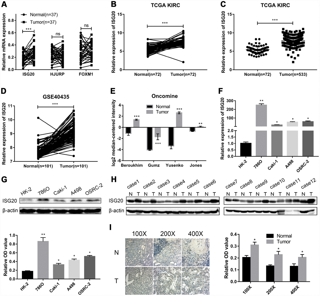 ISG20 was up-regulated in ccRCC. (A) The mRNA expression level of ISG20 was elevated in ccRCC tissues. (B–E) ISG20 was up-regulated in ccRCC tissues in the online databases (TCGA KIRC dataset, GSE40435 dataset, and Oncomine database). (F, G) Both mRNA and protein expression levels of ISG20 were elevated in ccRCC cell lines. (H, I) The protein expression level of ISG20 was higher in ccRCC tissues than that in normal tissues. ccRCC: clear cell renal cell carcinoma; TCGA KIRC: The Cancer Genome Atlas Kidney Clear Cell Carcinoma; qRT-PCR: quantitative real-time PCR; IHC: Immunohistochemistry. Data are represented as mean ± SD. ***, P 