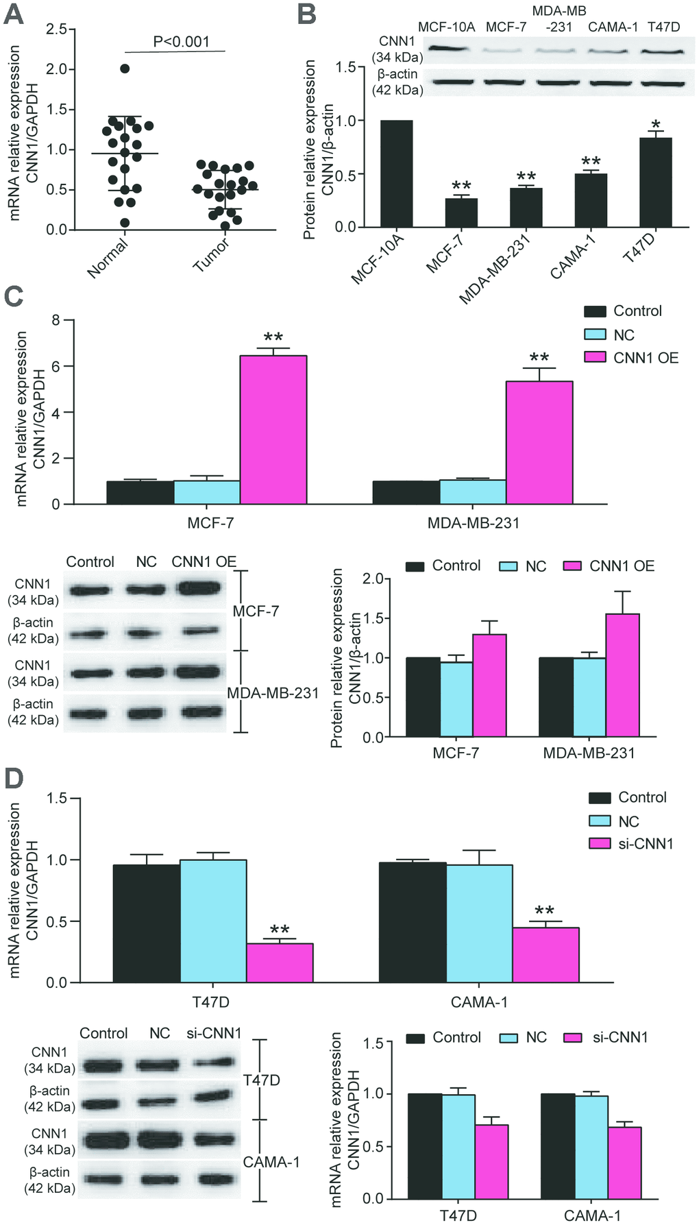 The CNN1 expression was decreased in BRCA tissues and cells. (A) The downregulation of CNN1 in breast cancer tissues (n=20) compared with normal breast tissues (n=20). (B) The protein expression of CNN1 was decreased in BRCA cell lines compared with the healthy breast cell line. *PC) The CNN1 expression was upregulated after CNN1 overexpression transfected MCF-7 and MDA-MB-231 cells. Control, the cells were cultured without any treatment. NC, the cells were treated with the negative control. CNN1 OE, the cells were treated with CNN1 overexpression. *PD) The CNN1 expression was downregulated after CNN1 small interfering RNA (siRNA) transfected T47D and CAMA-1 cells. Control, the cells were cultured without any treatment. NC, the cells were treated with the negative control. si-CNN1, the cells were transfected with CNN1 siRNA. *P