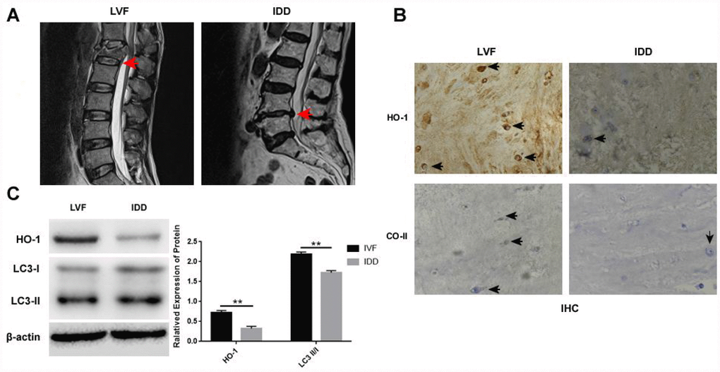 Distinct morphology and HO-1 expression in NP tissues isolated from LVF and IDD groups. (A) Representative lumbar MRI photographs show the grade I and grade V intervertebral discs in the LVF (left) and IDD (right) patient tissues, respectively, as indicted by the red arrows. The tissues were graded using the Pfirrmann’s grading system. (B) Immunohistochemical staining shows the expression of HO-1 and collagen II expression in the NPCs from LVF and IDD patients. The black arrows indicate positively staining cells. (C) Western blot shows the proteins expressions of HO-1 and LC3-II/I in NP tissue samples from LVF and IDD patients. Note: The data represents mean ± SD of three experiments; **p